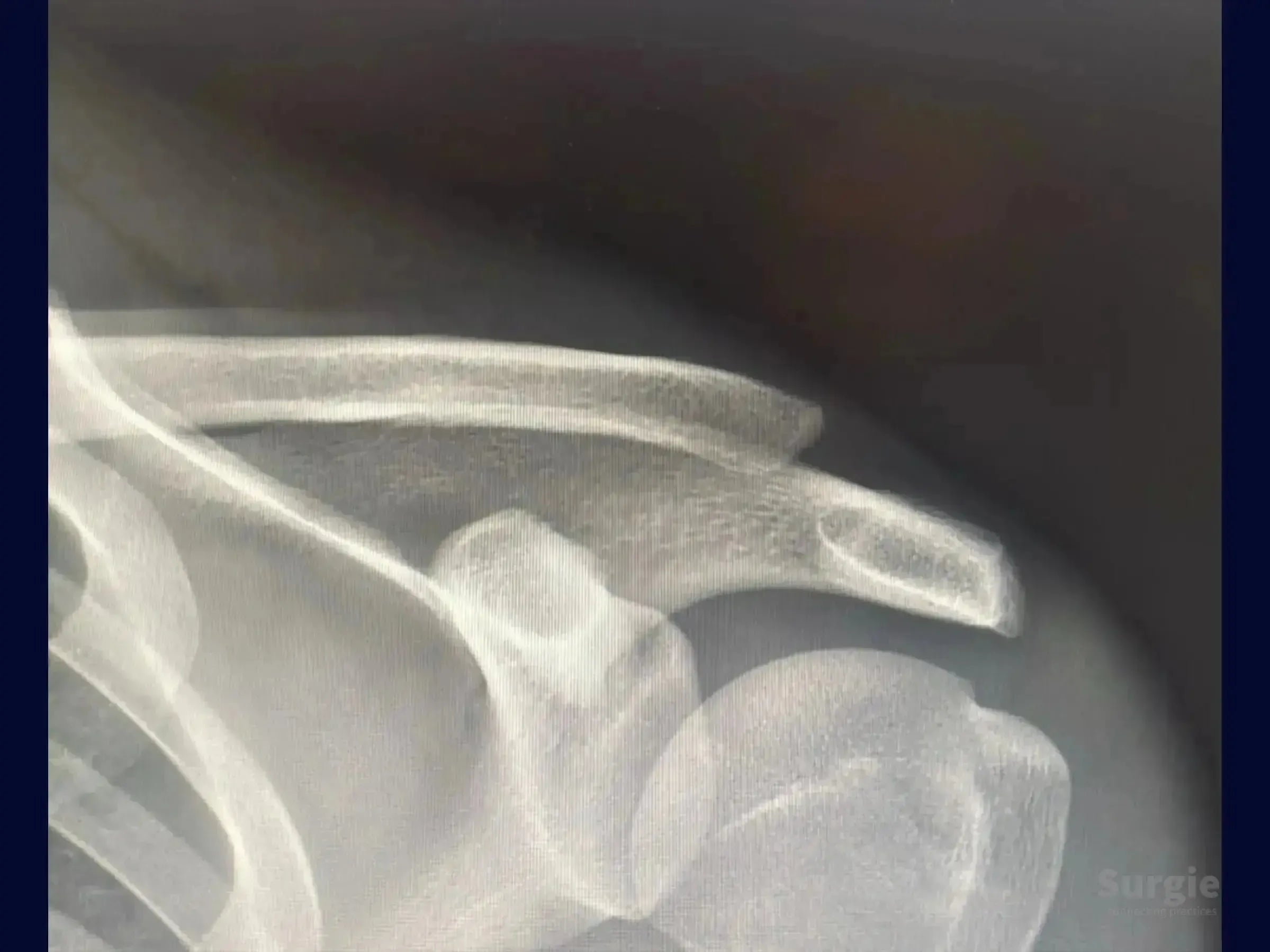Radiographic view showing acromioclavicular joint dislocation with clavicle displacement and bone anatomy.