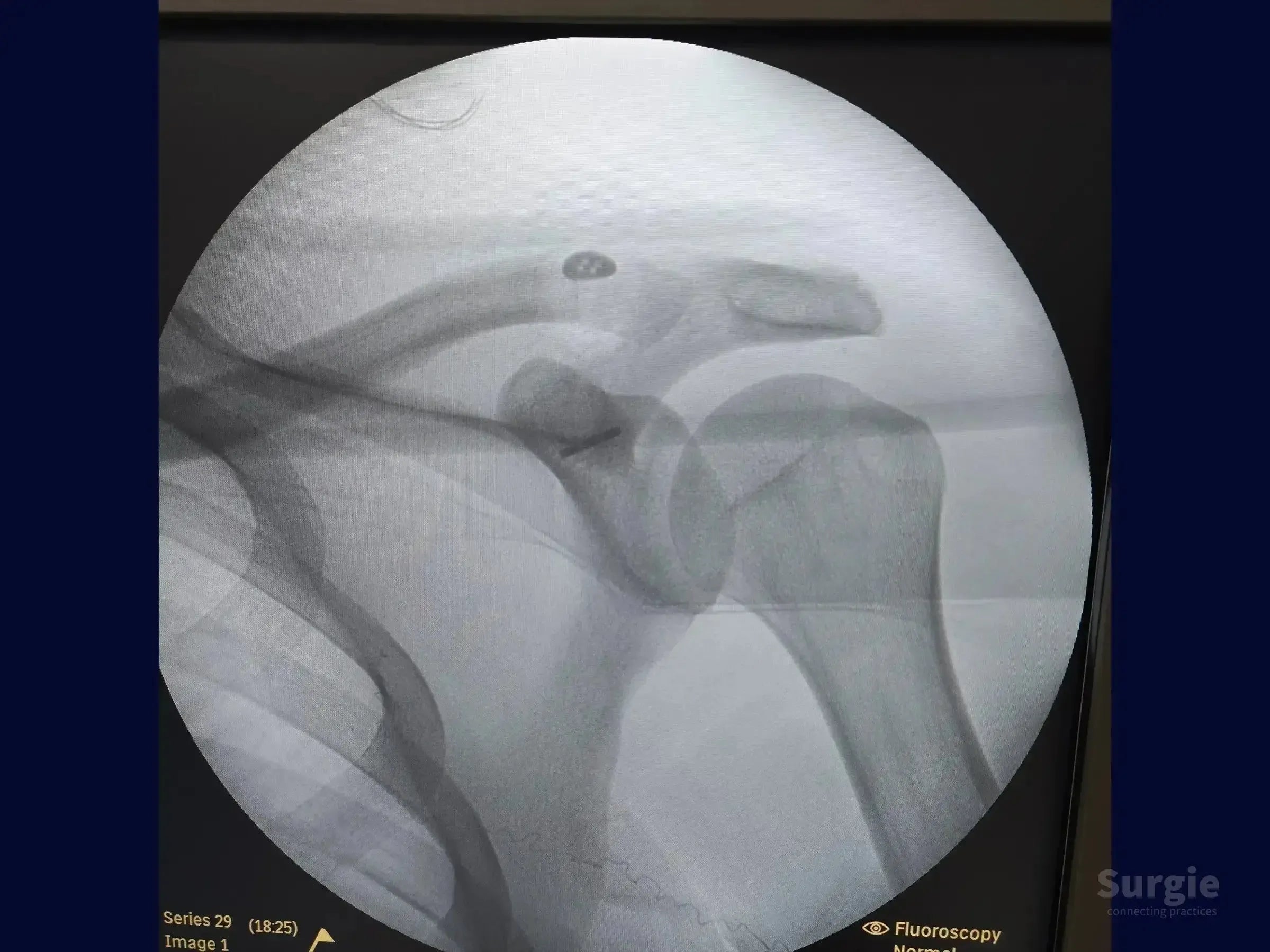 Fluoroscopic X-ray showing a TightRope device stabilizing an acromioclavicular dislocation in the shoulder.