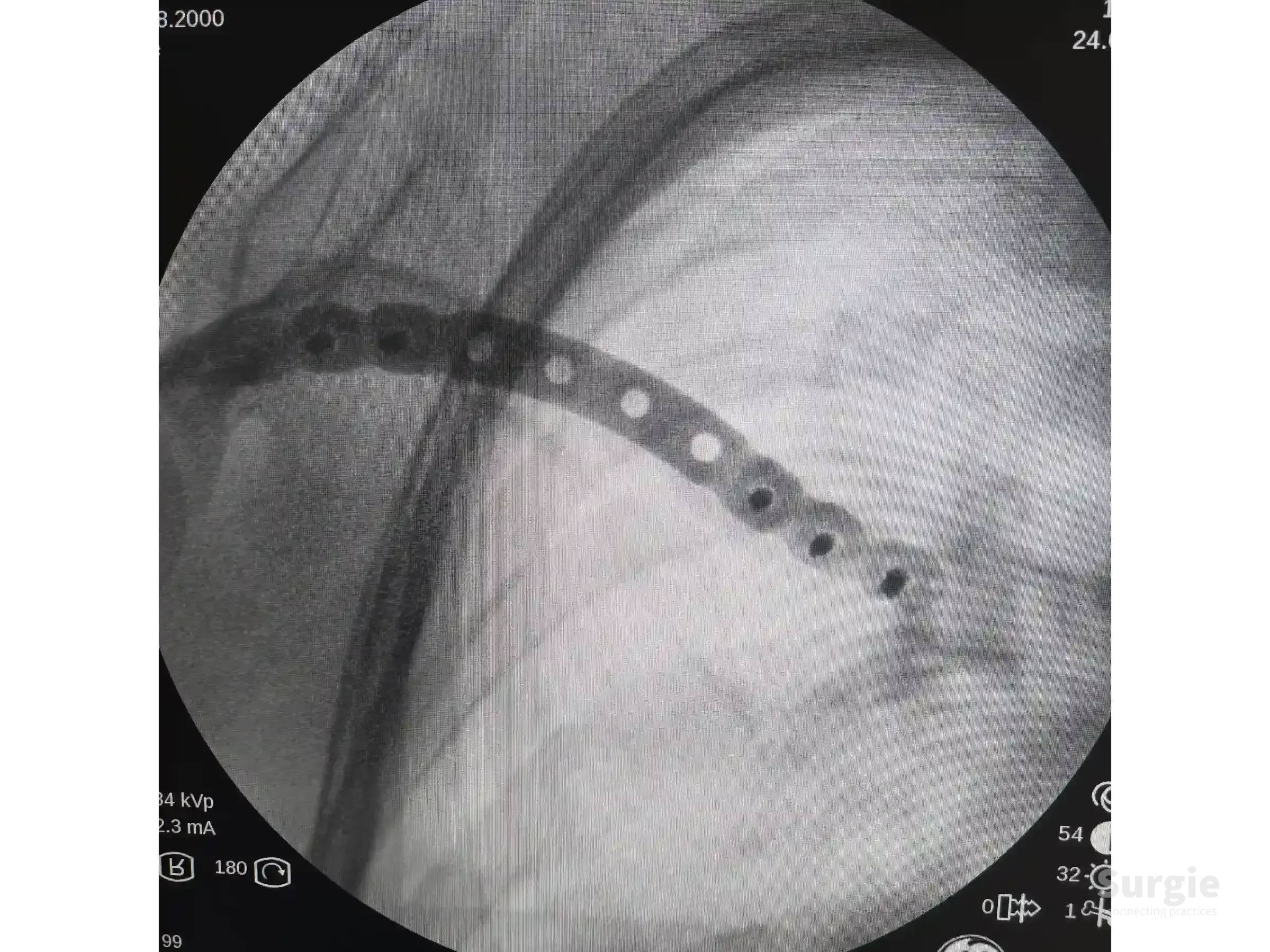 Fluoroscopic view of a metal orthopedic plate fixating a midshaft clavicle fracture with screw holes visible.