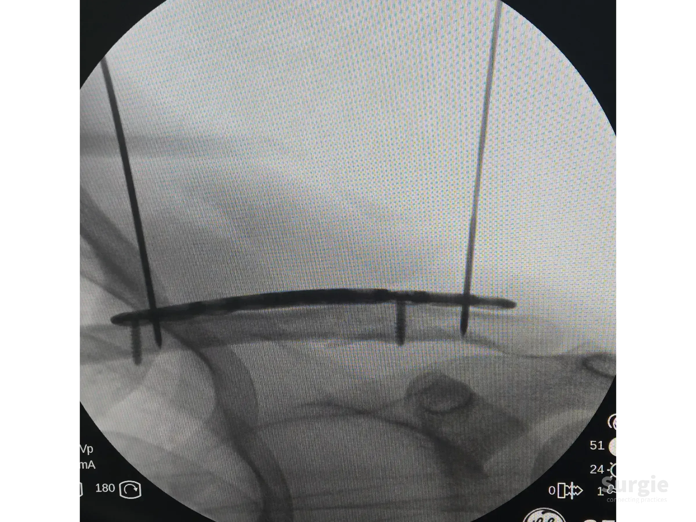 Fluoroscopic view of a clavicle fracture fixed with an anatomic plate, guide wires, and screws for surgical alignment.