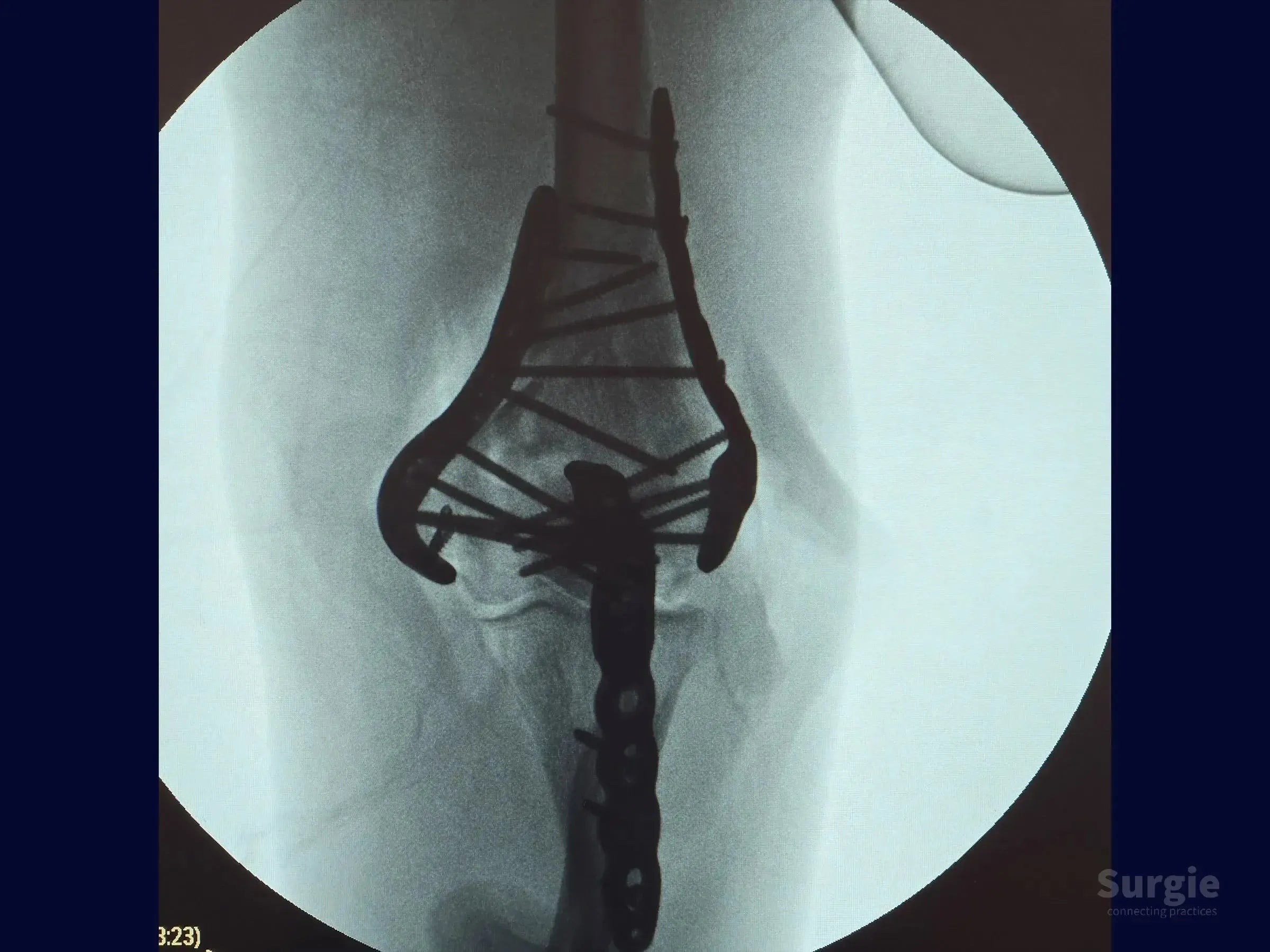 X-ray showing distal humerus fracture fixed with dual locking plates and screws for articular reconstruction.