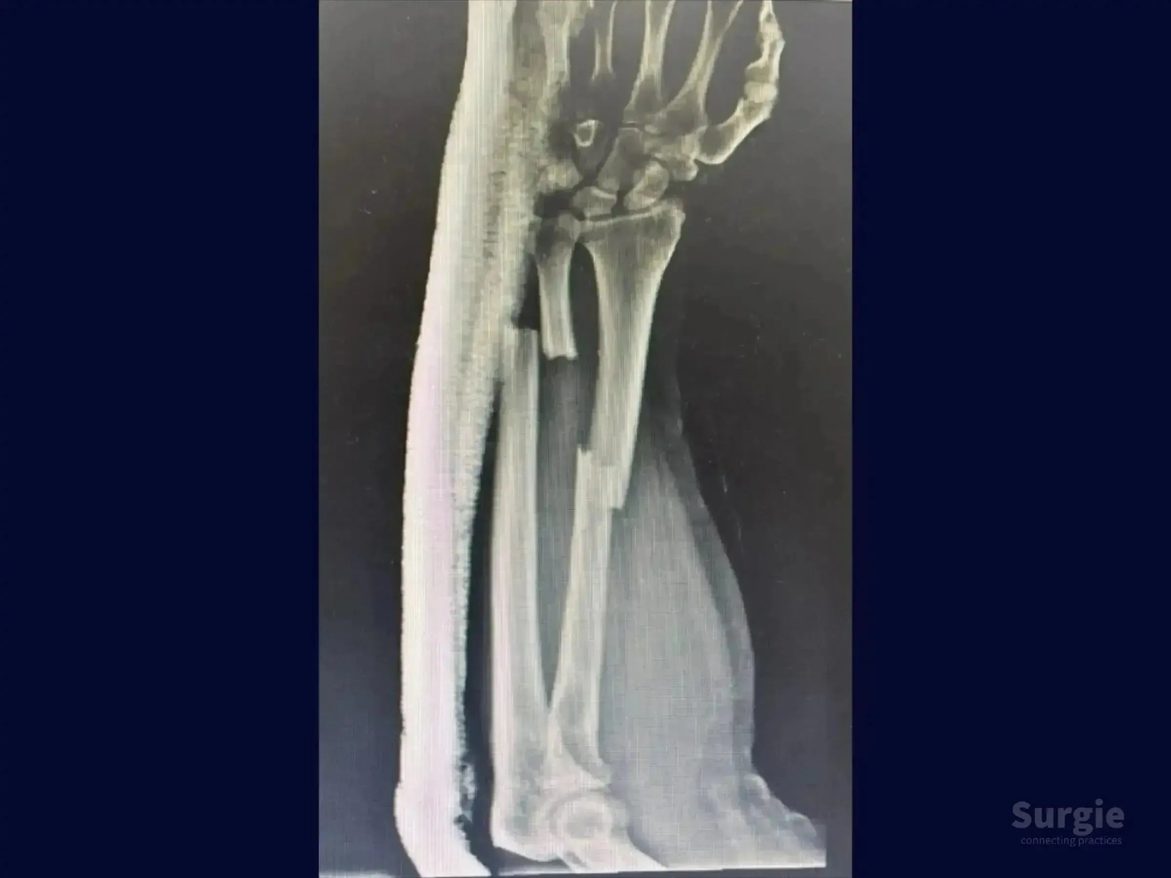 X-ray showing a diaphyseal fracture of the radius and ulna with significant bone displacement and soft tissue swelling.