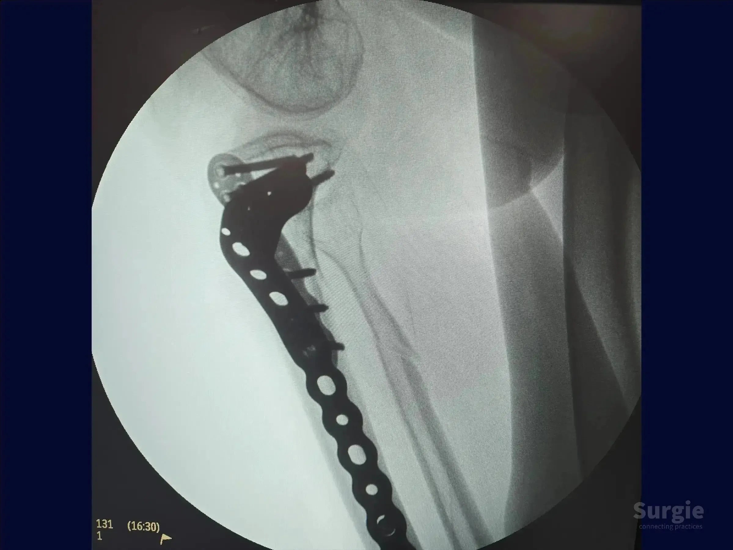 X-ray showing a contoured metal plate and screws fixating a diaphyseal tibia fracture with bone deformity.