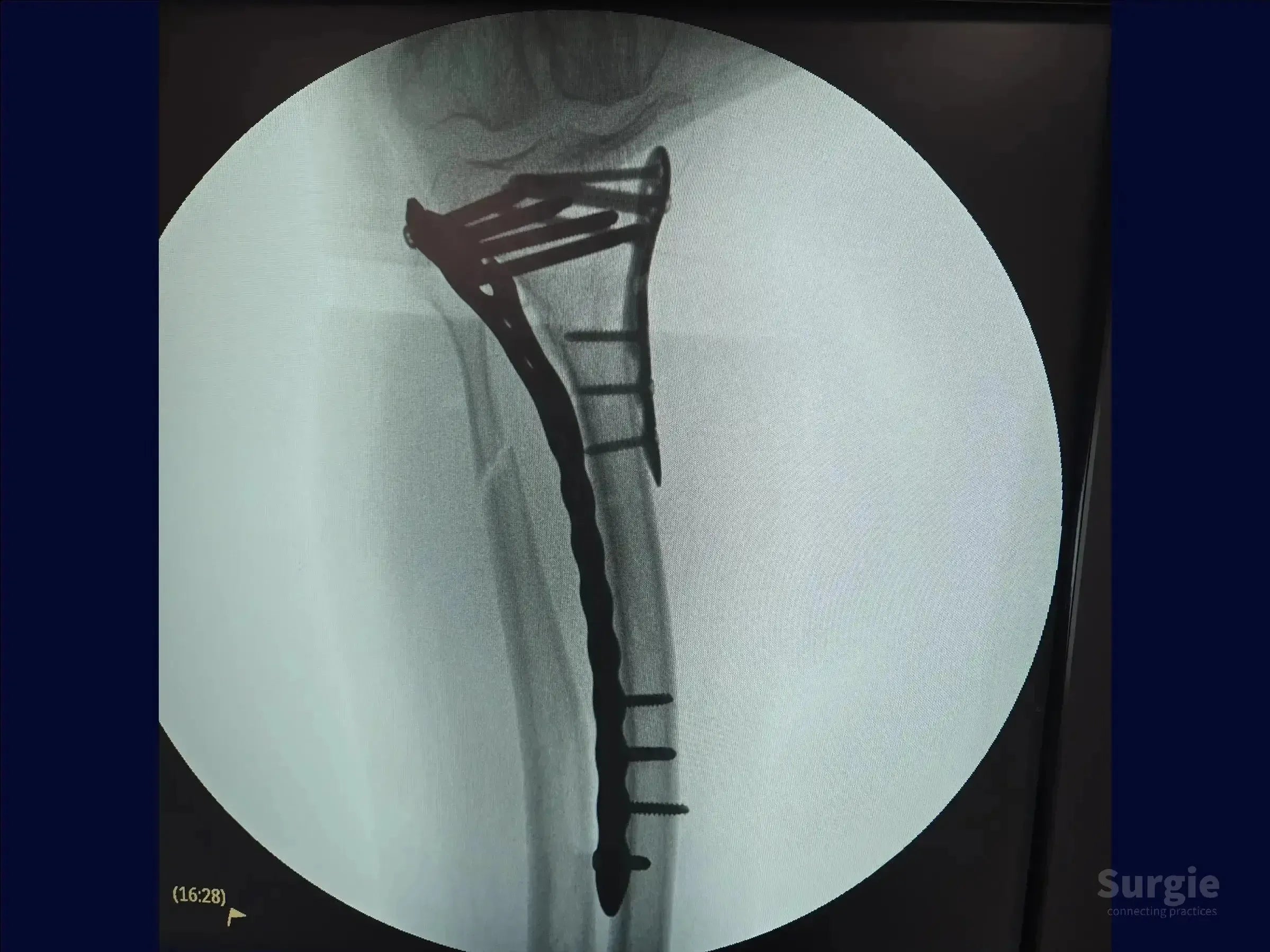 Fluoroscopic X-ray showing a tibia fracture stabilized with a metallic anatomical plate and multiple fixation screws.
