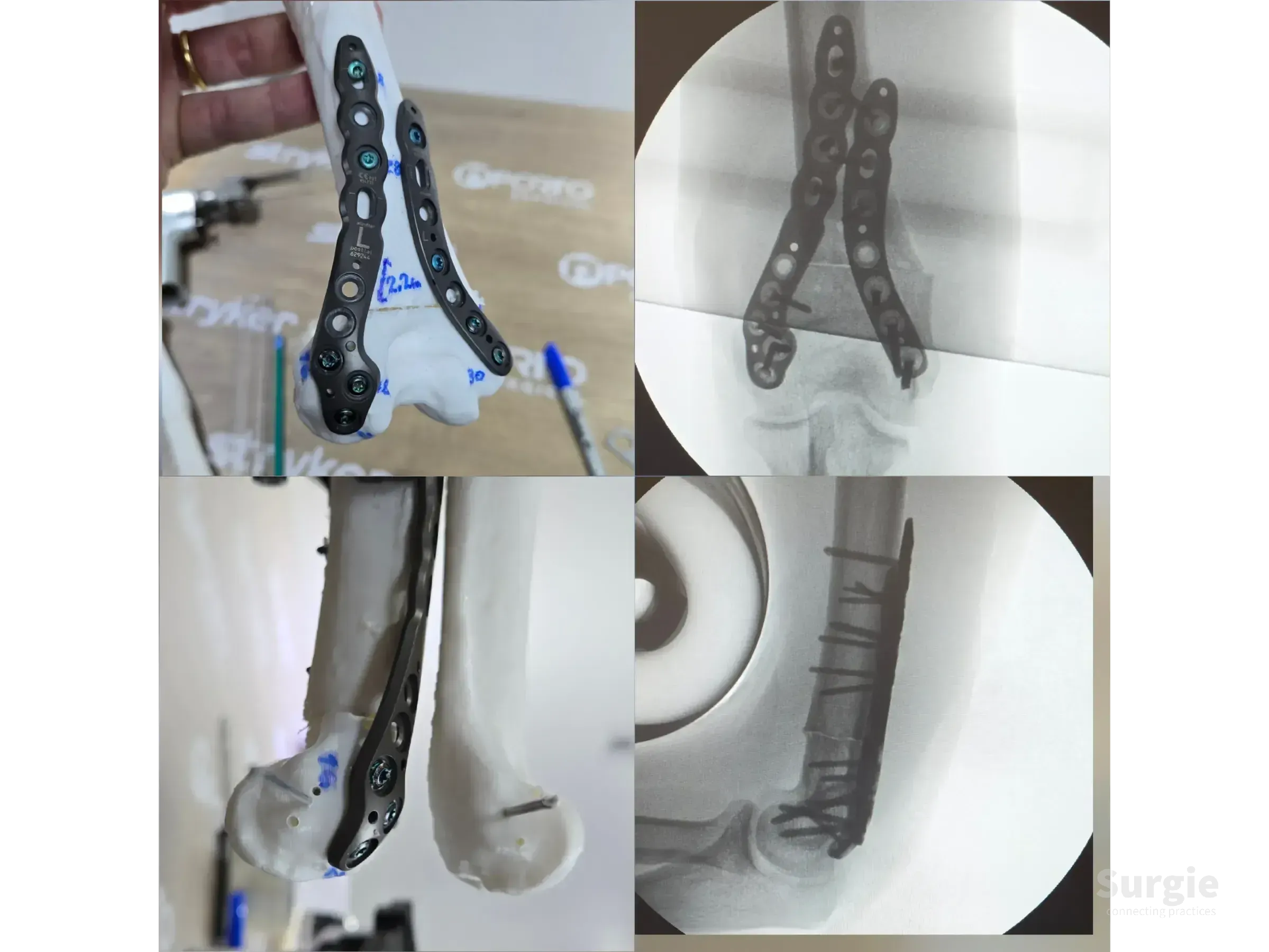 3D printed humerus model with locking plates and corresponding X-ray images for cubitus varus deformity correction.