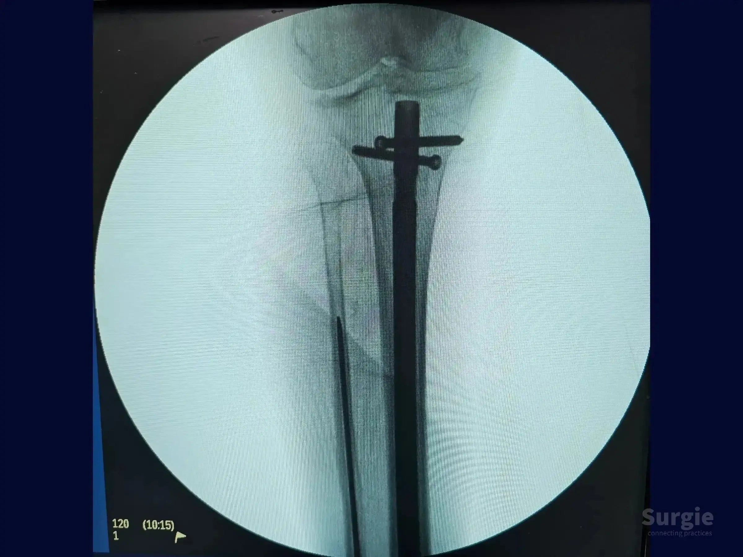 X-ray showing a metallic intramedullary nail in the tibia secured with locking screws via a suprapatellar approach.