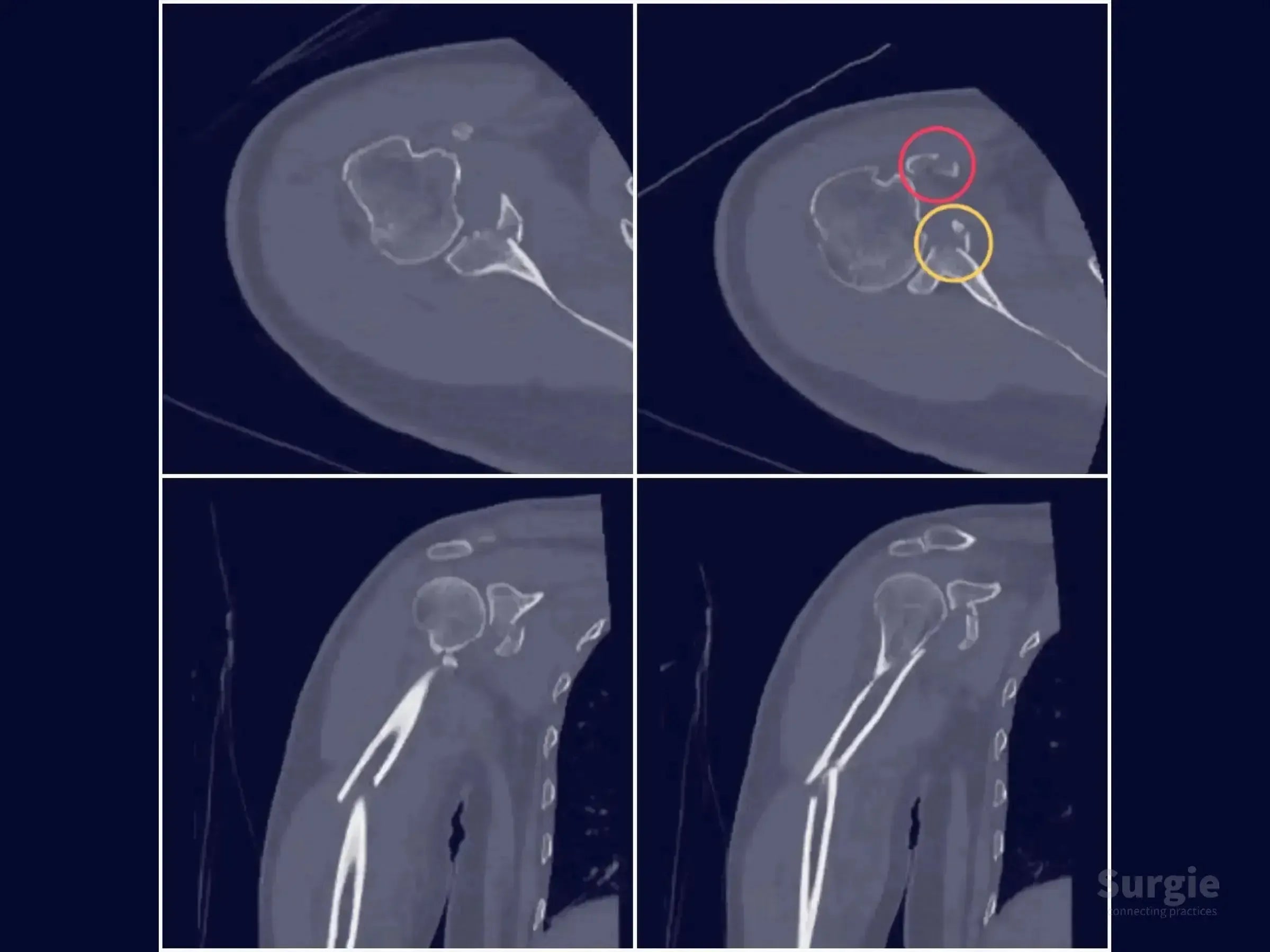 CT scan images showing glenoid fracture displacement with red and yellow circles highlighting bone fragments for surgery.
