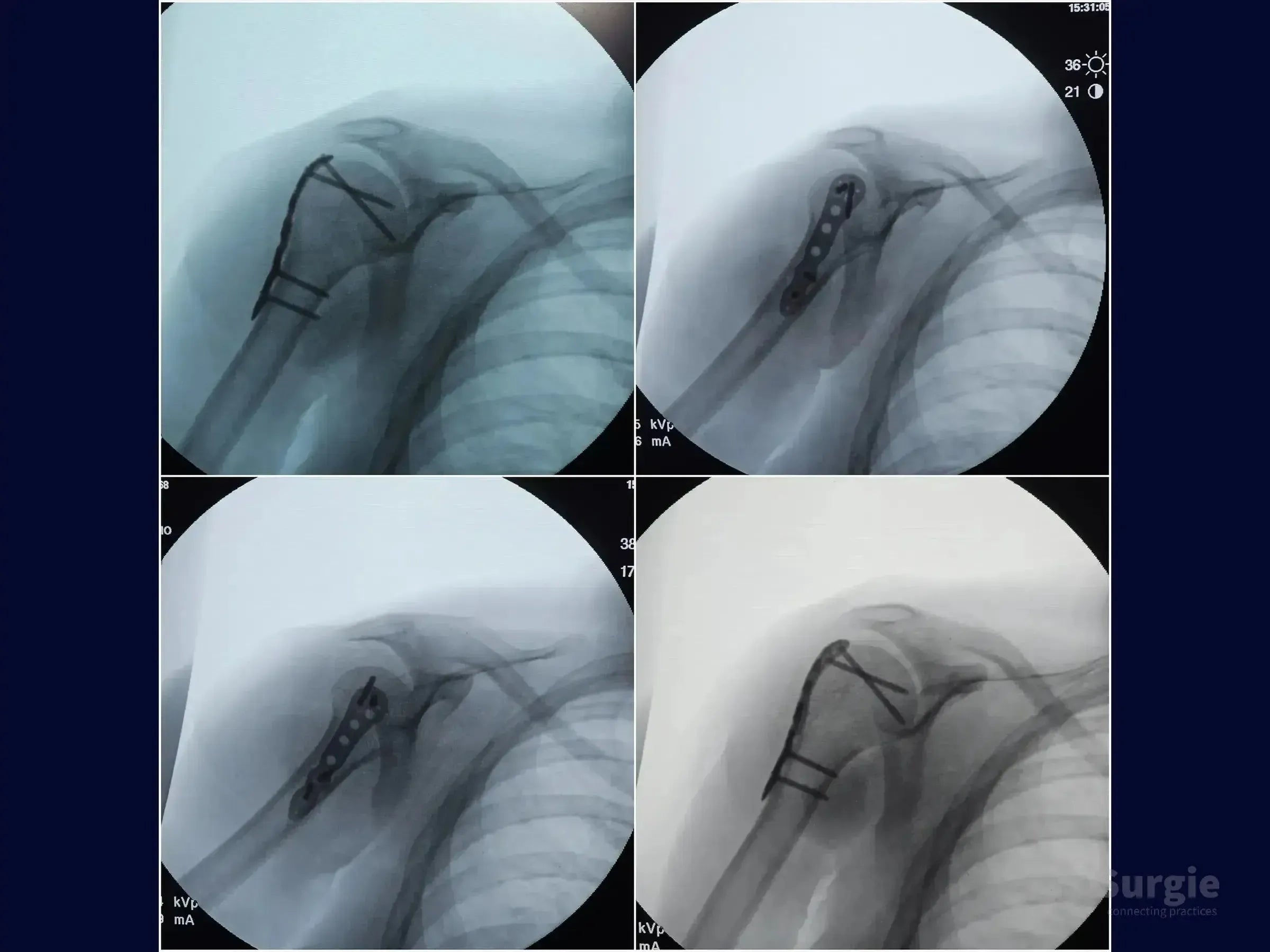 X-ray showing humeral greater tuberosity fracture fixation with a locking plate and high-strength sutures.