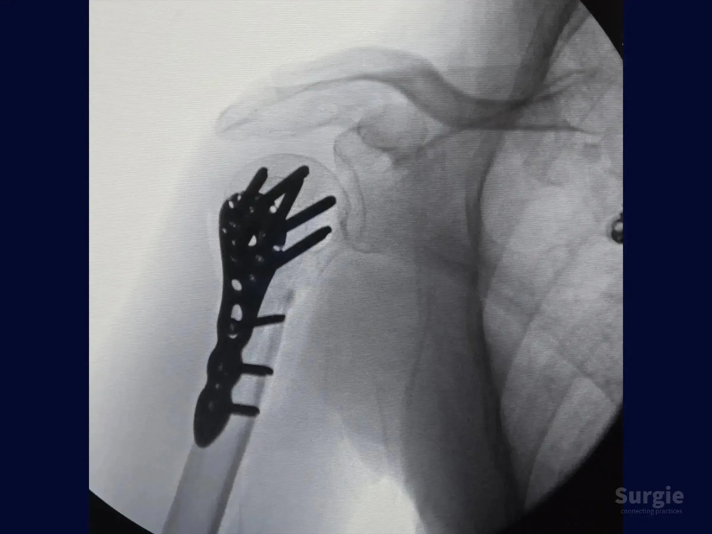X-ray showing a metal locking plate and screws fixating a proximal humerus fracture in the shoulder joint.