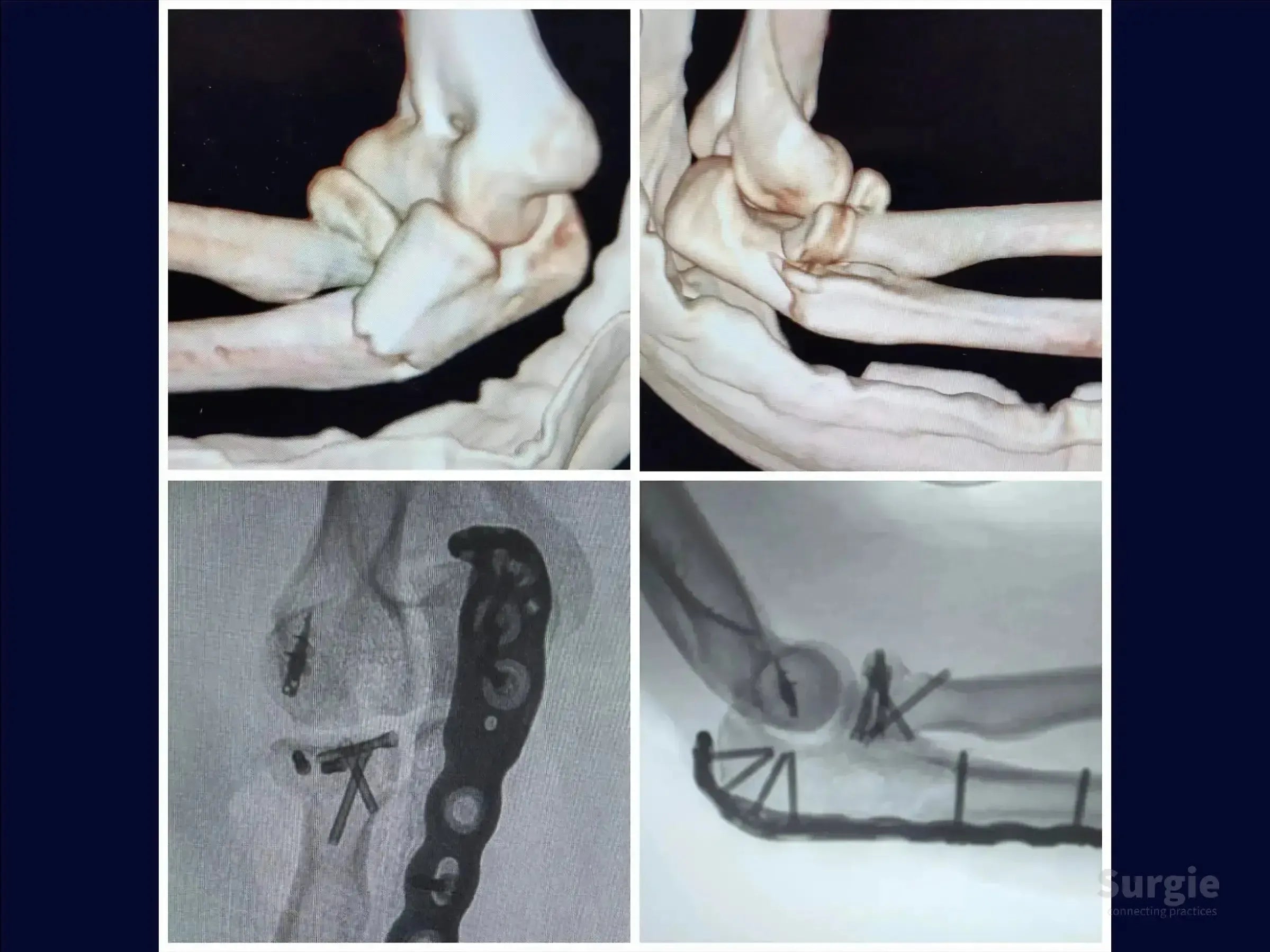 3D CT scans and X-rays showing Monteggia variant elbow fracture repair with metal plates and screws.