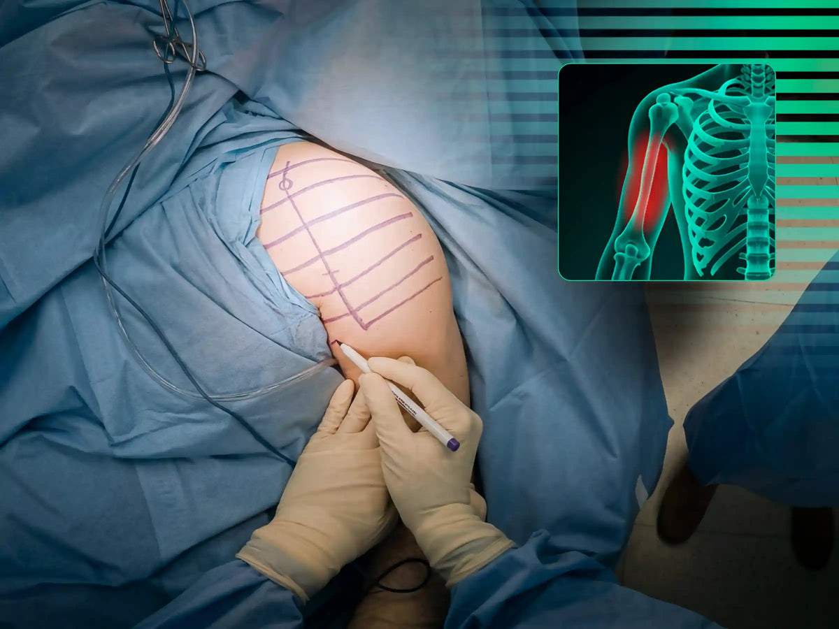 Proximal Humerus [Case 07] - Head-Split in a Young Patient with Plate and Screws