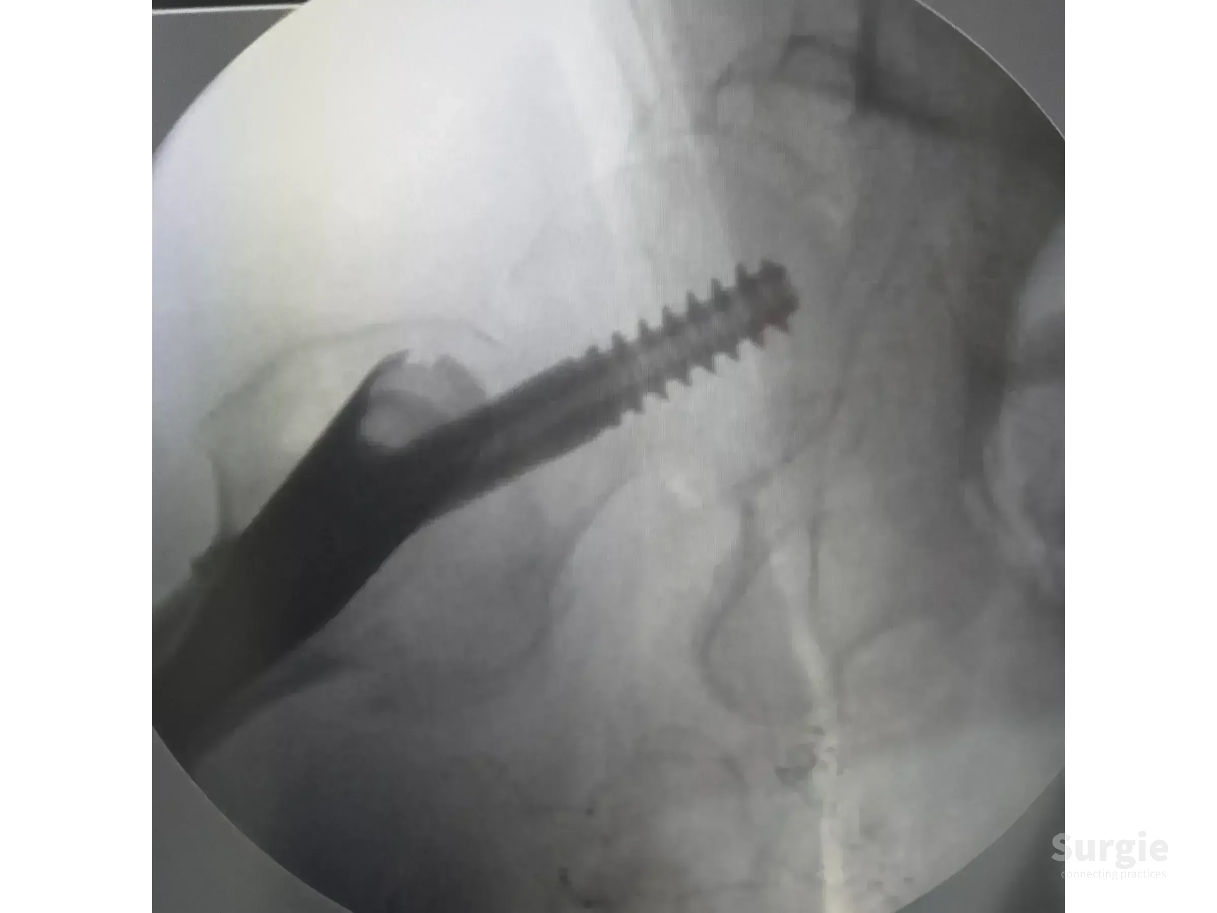 Fluoroscopic view of a metallic intramedullary nail and cephalic screw inserted into a proximal femur fracture.