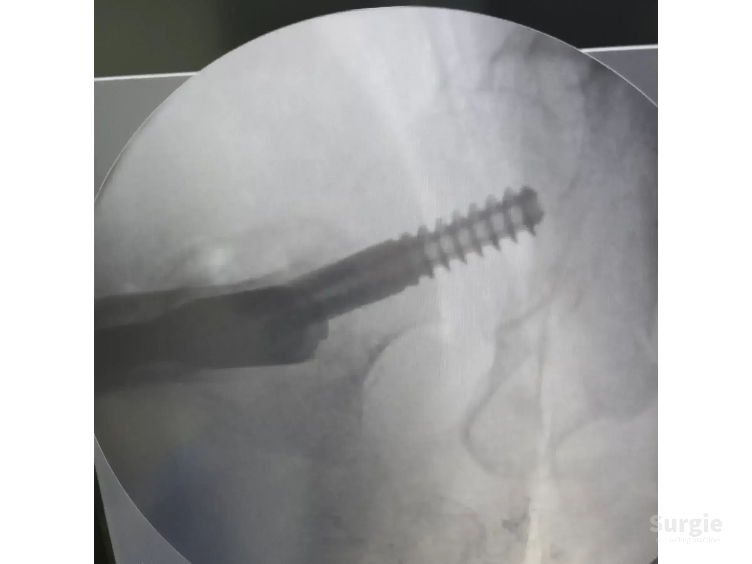 Fluoroscopic view of a proximal femoral intramedullary nail and cephalic screw during surgical reduction.
