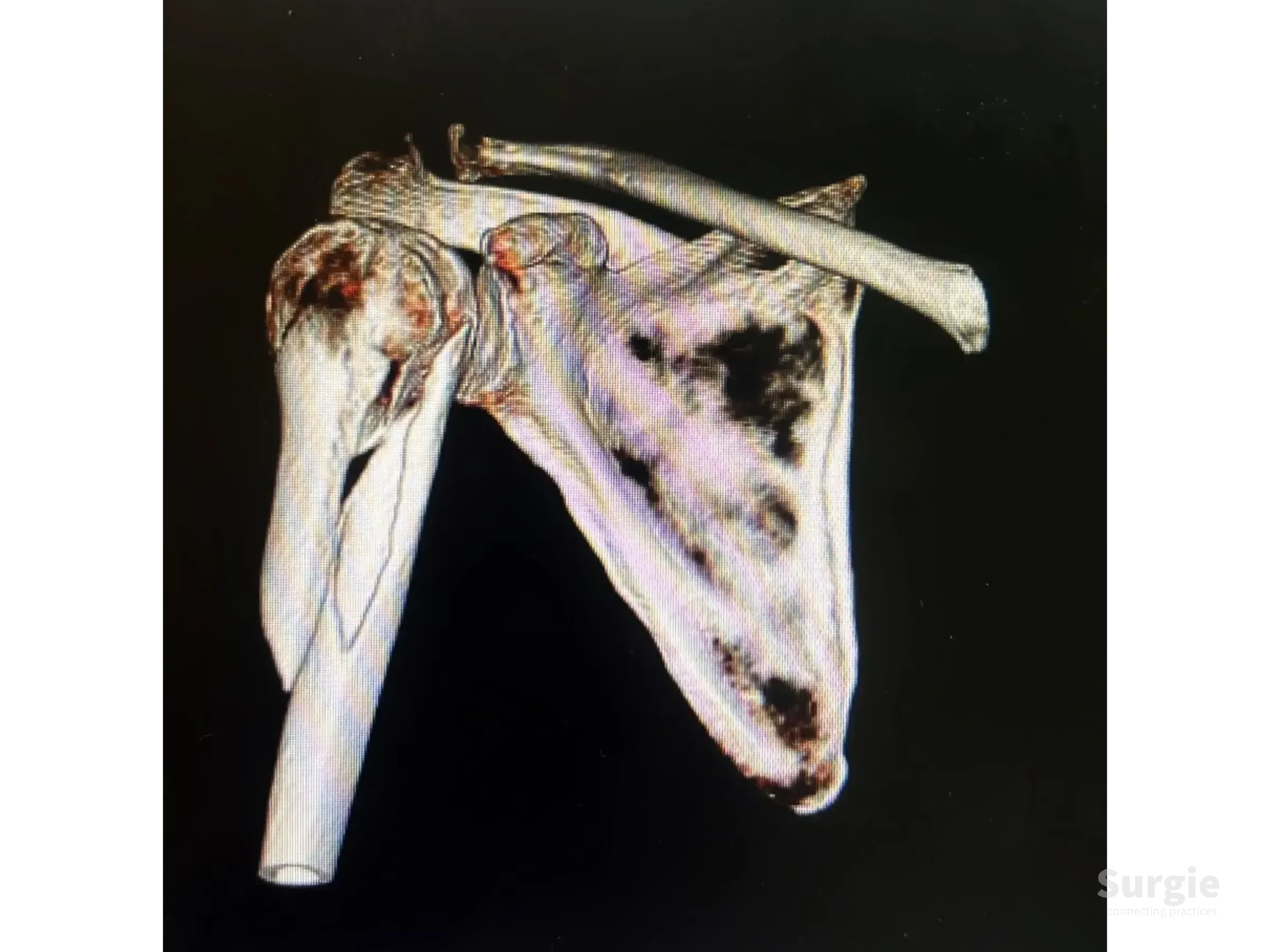 3D CT scan showing a fractured proximal humerus with an intramedullary nail inserted for surgical stabilization.