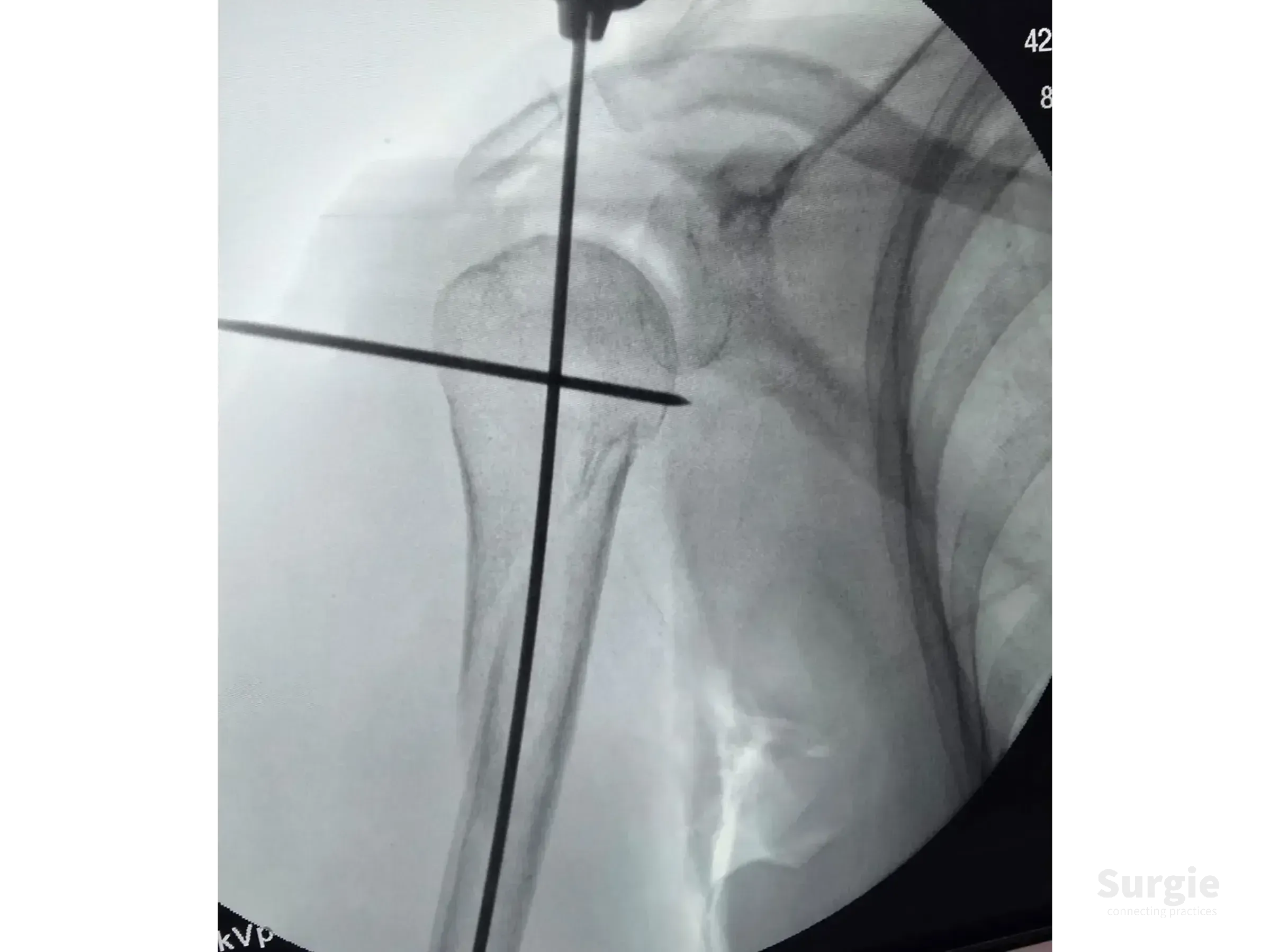 Fluoroscopic view of a proximal humerus fracture with a guide wire and Kirschner wire positioned for intramedullary nailing.