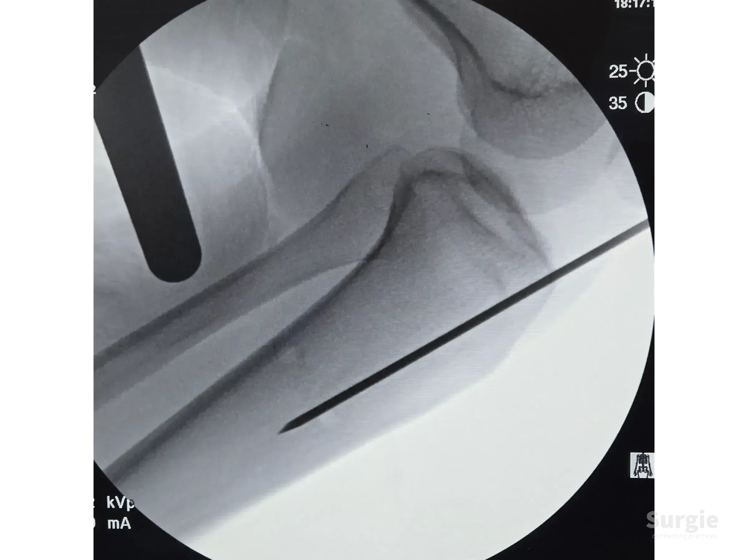 Fluoroscopic view of a guide wire inserted into the proximal tibia during an infrapatellar intramedullary nailing procedure.