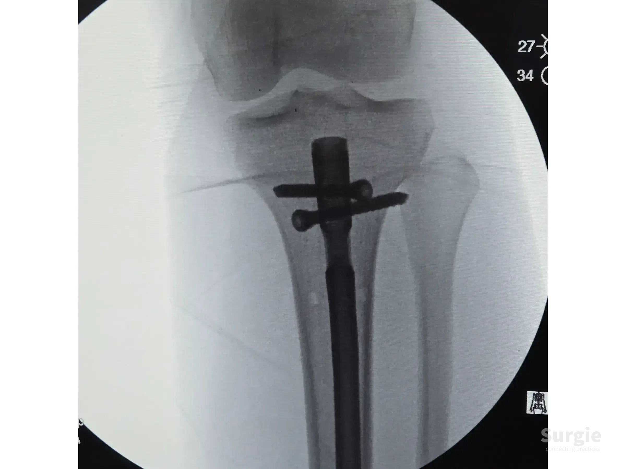 Fluoroscopic X-ray showing an intramedullary tibial nail with proximal locking screws in the proximal tibia.