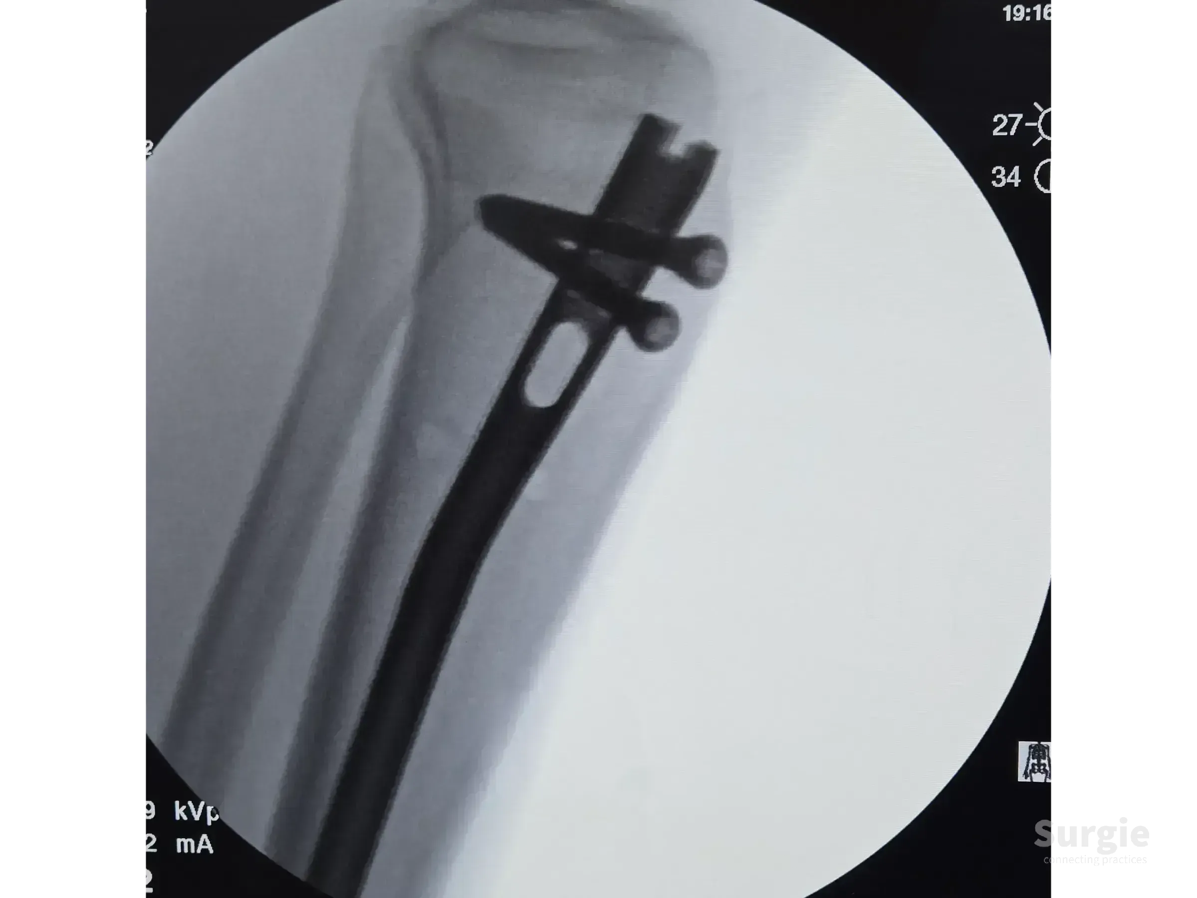 Fluoroscopic view of a metallic intramedullary tibial nail with proximal locking screws in the proximal tibia.