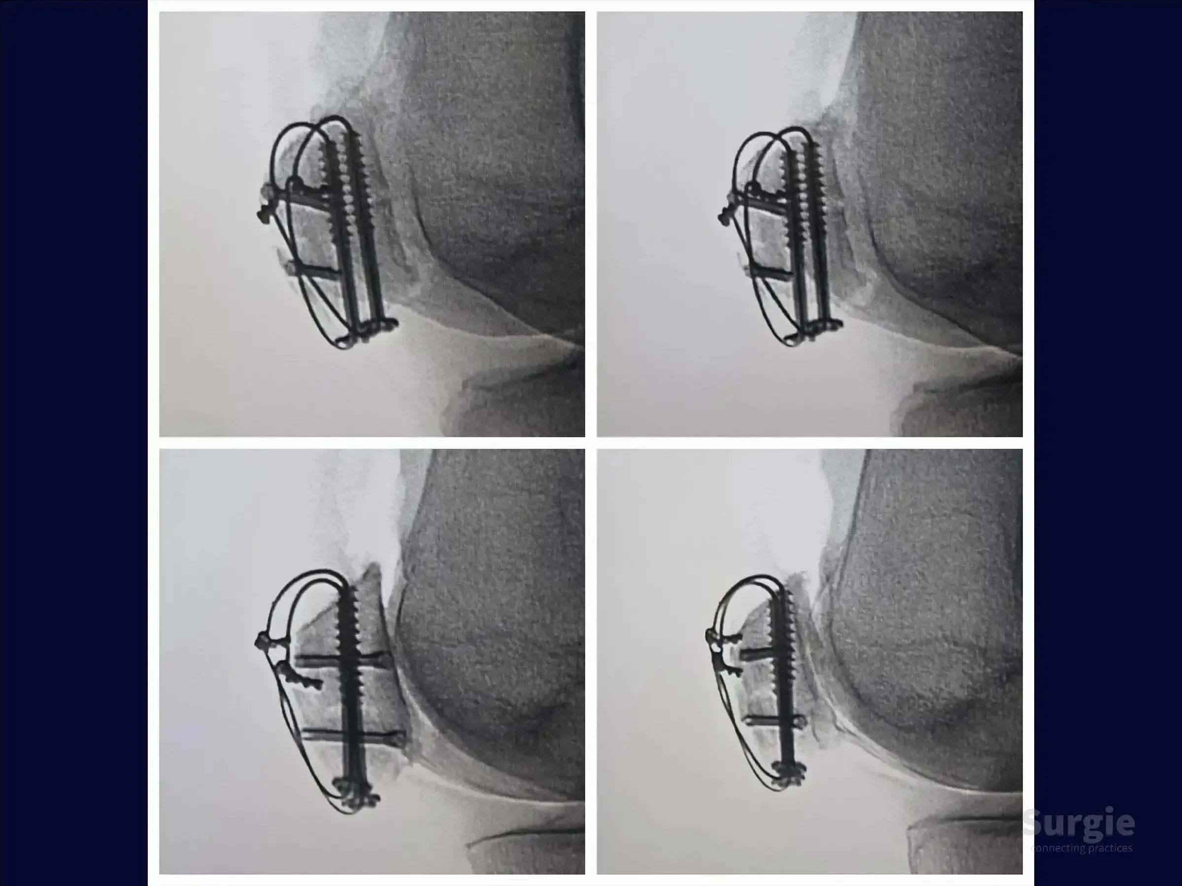 X-ray showing multi-fragmentary patella fracture fixation with cannulated screws and cerclage wiring.