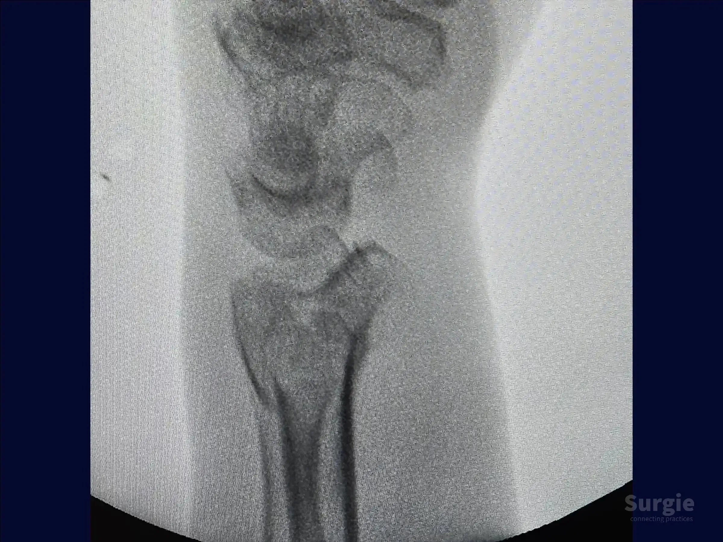 Grayscale X-ray showing a multifragmentary distal radius fracture with displaced bone segments in the wrist joint.