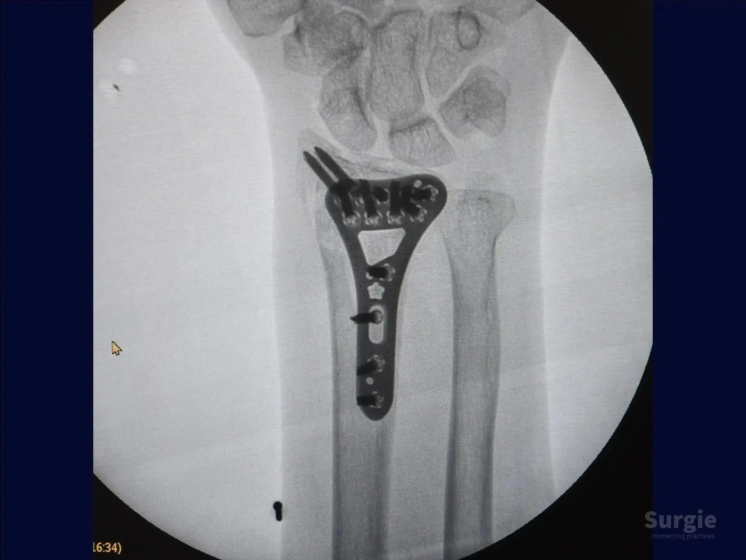 X-ray showing a distal radius fracture stabilized with a metallic volar plate and multiple locking screws.