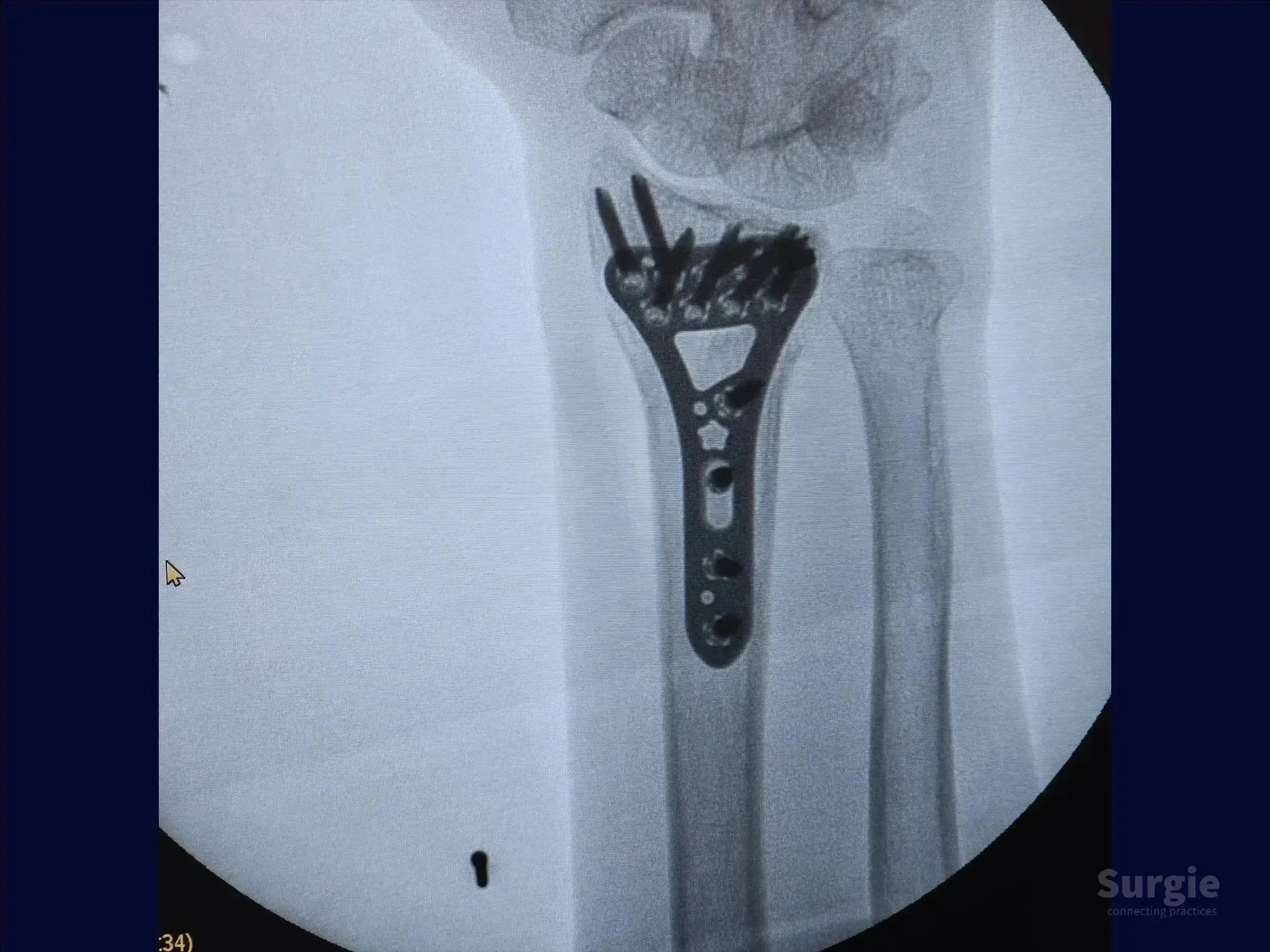X-ray showing a distal radius fracture stabilized with a volar plate and multiple locking screws.