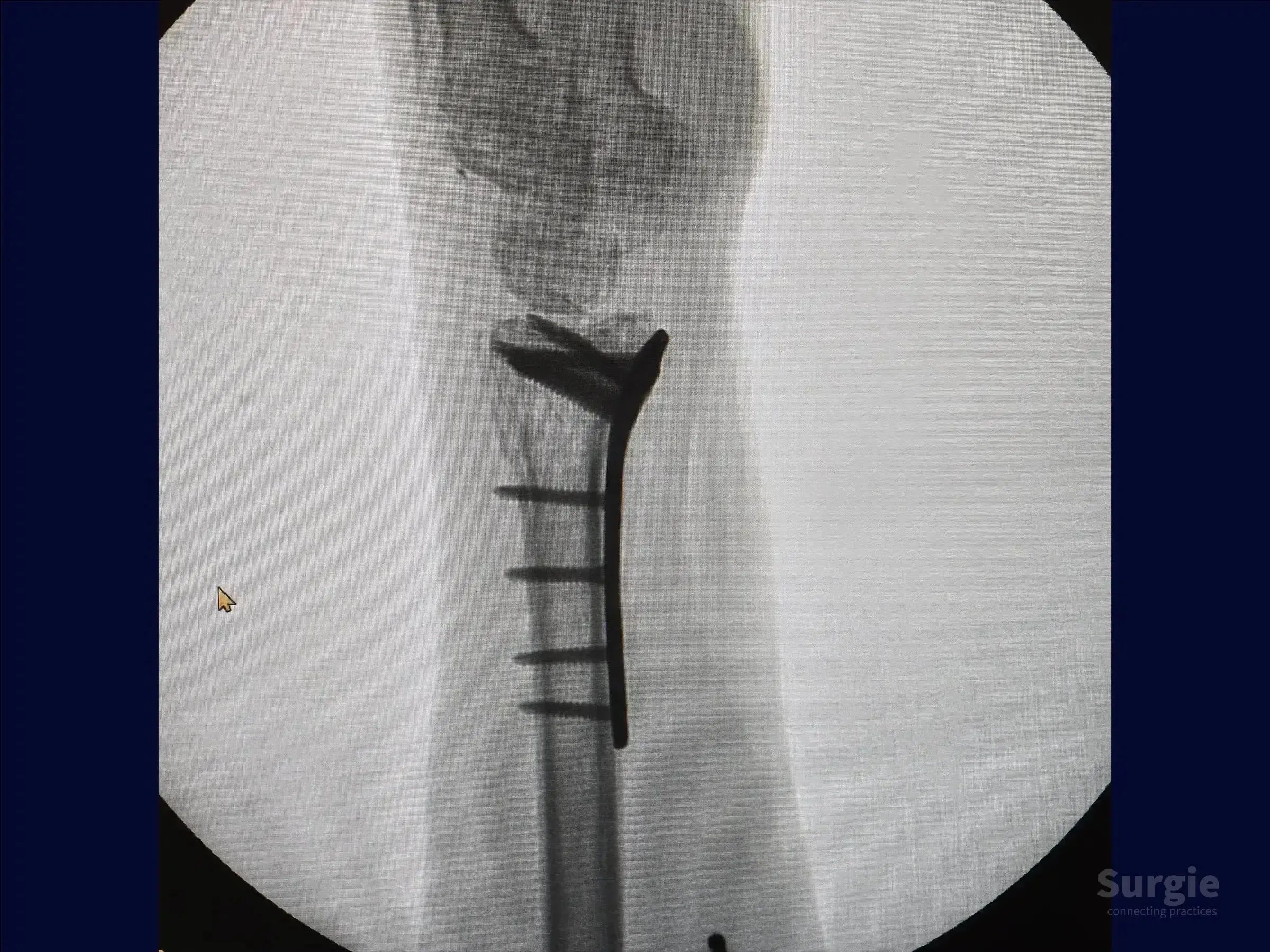 X-ray showing a distal radius fracture fixed with a volar plate and multiple screws for bone stabilization.