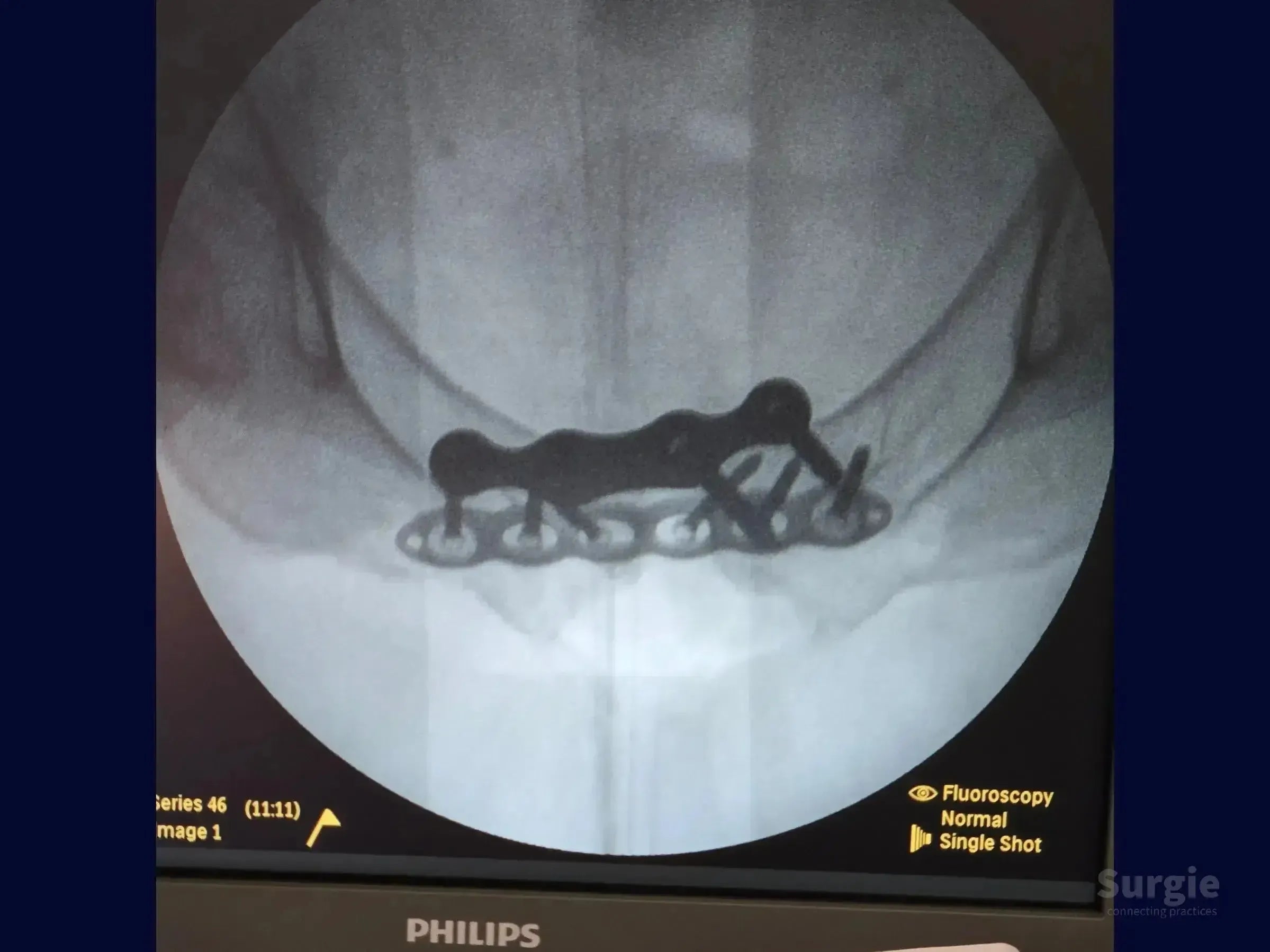 Fluoroscopic X-ray showing a metal fixation plate and screws stabilizing a pubic symphysis dislocation.