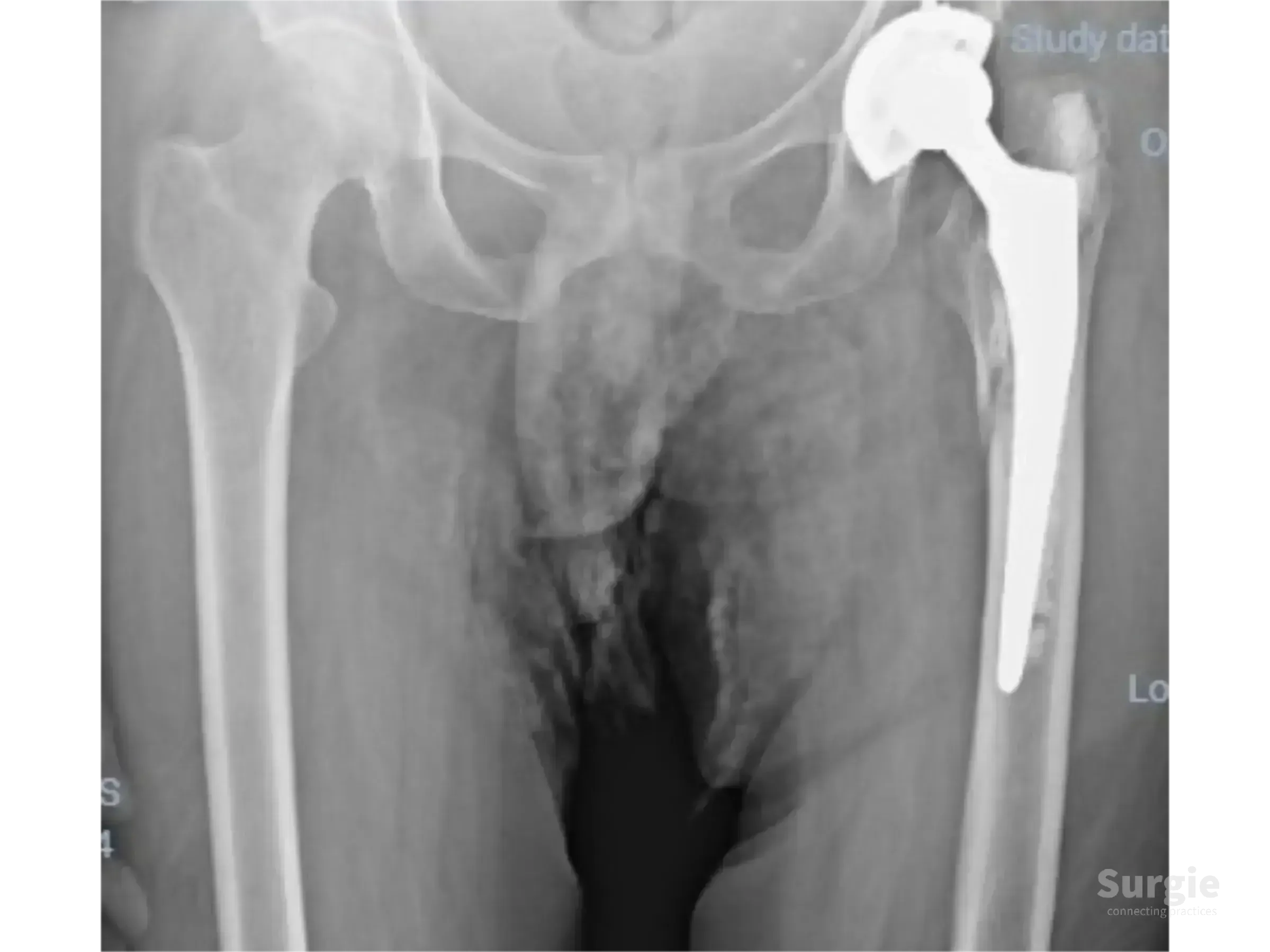 X-ray of a periprosthetic hip fracture showing a cemented femoral prosthesis and trochanteric plate fixation.