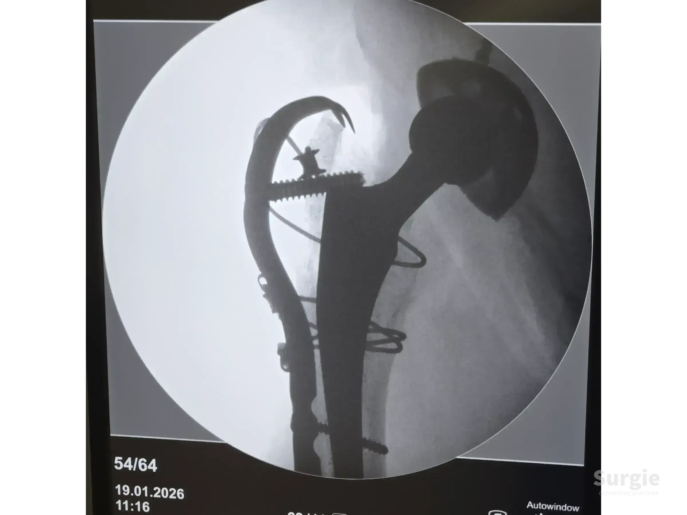 X-ray of a periprosthetic hip fracture fixed with a trochanteric plate, cortical screws, and metal cerclage cables.