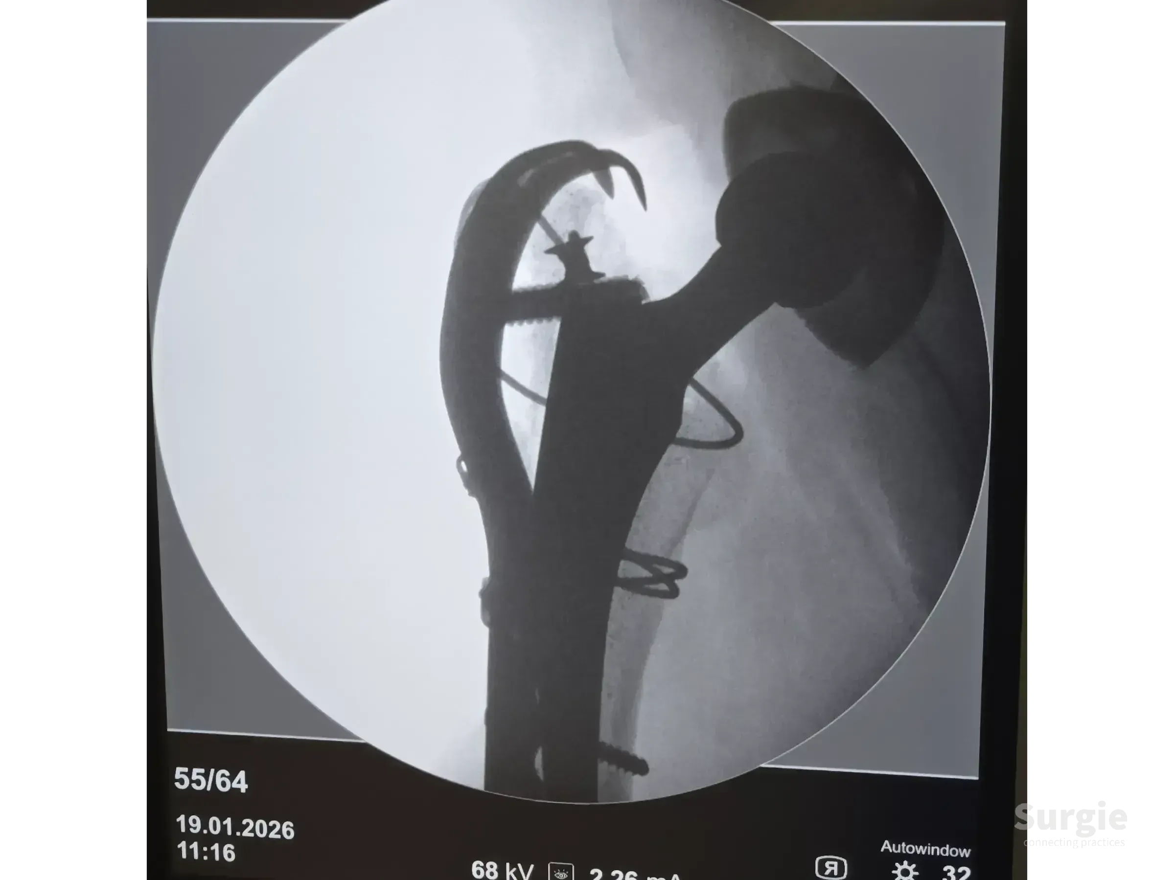 X-ray of a periprosthetic hip fracture fixed with a trochanteric plate, cortical screws, and metal cerclage cables.
