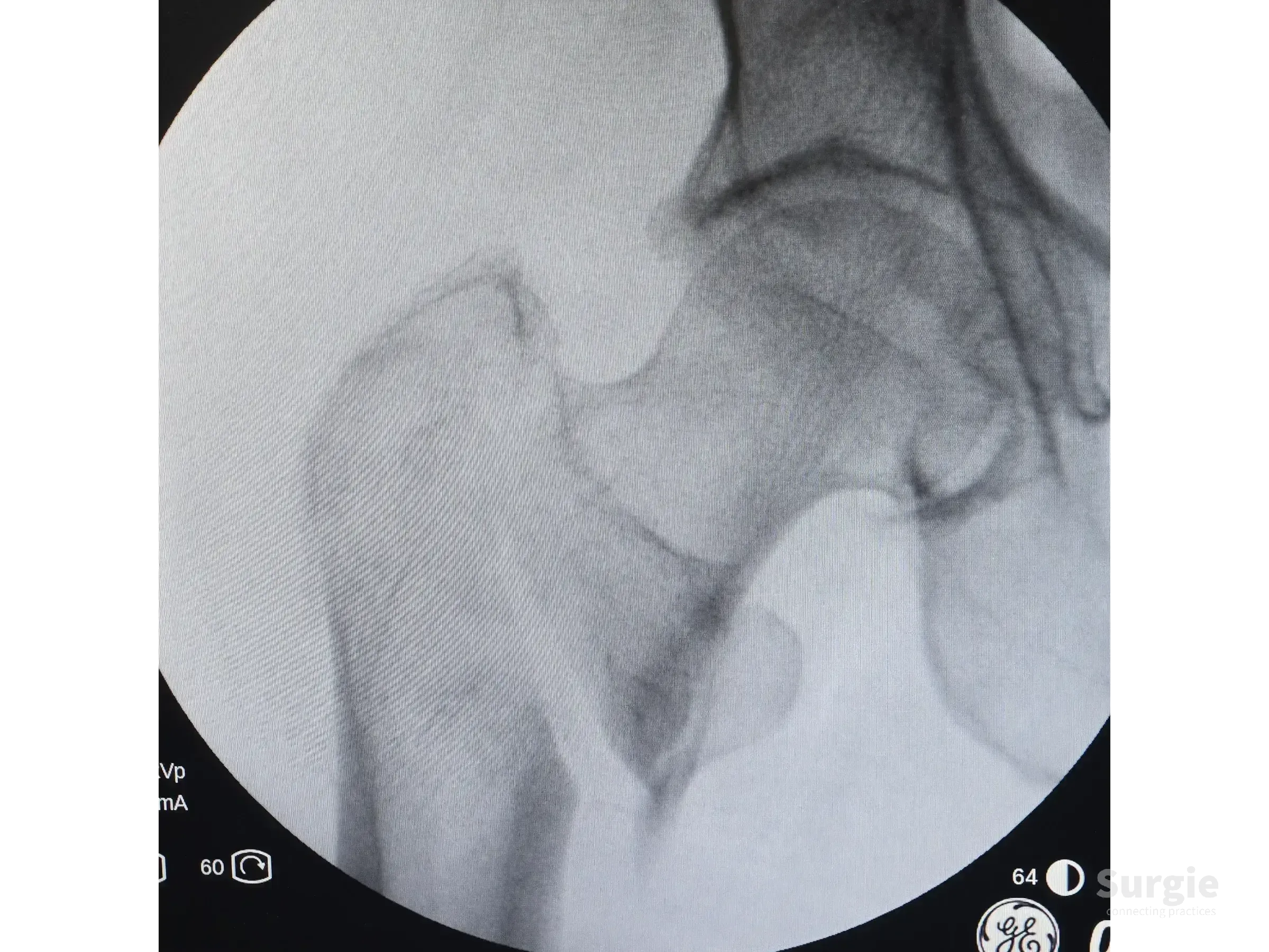 Fluoroscopic X-ray of an unstable proximal femur fracture showing the femoral head and neck in grayscale.