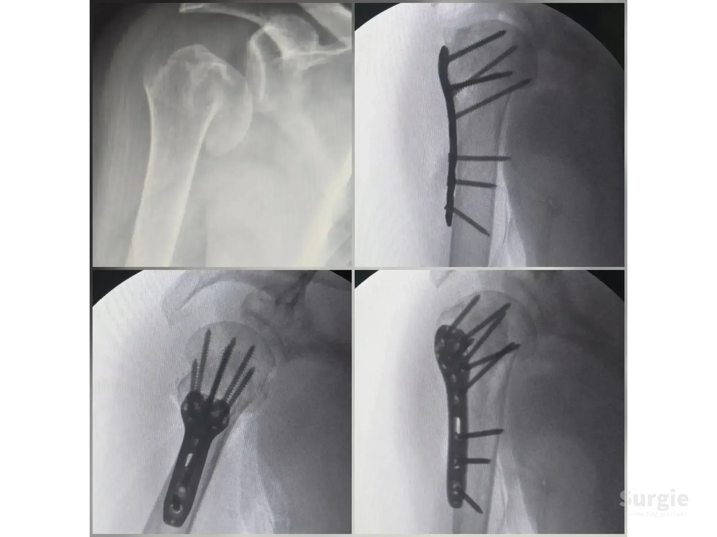 X-ray sequence showing surgical repair of a two-part proximal humerus fracture using a metal locking plate and screws.