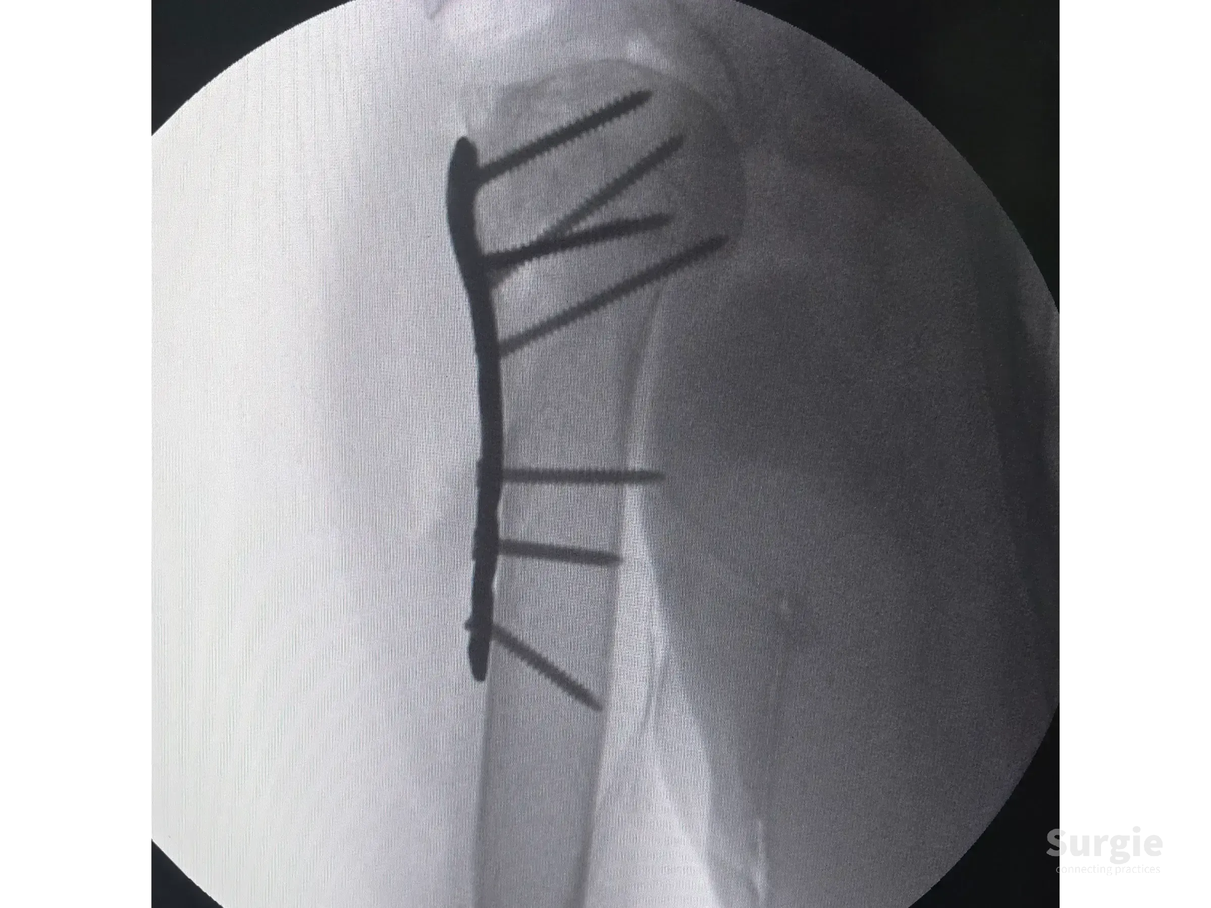 X-ray of a proximal humerus fracture fixed with a metallic locking plate and multiple surgical screws.