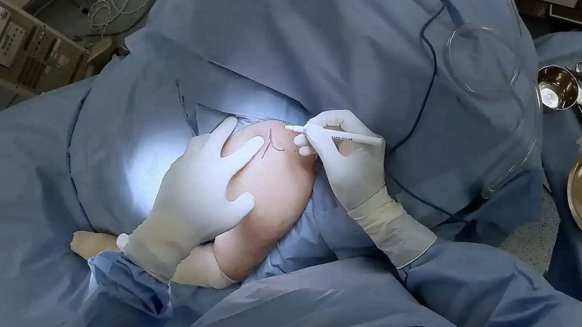 PROXIMAL HUMERUS [CASE 04] - Intramedullary Nail