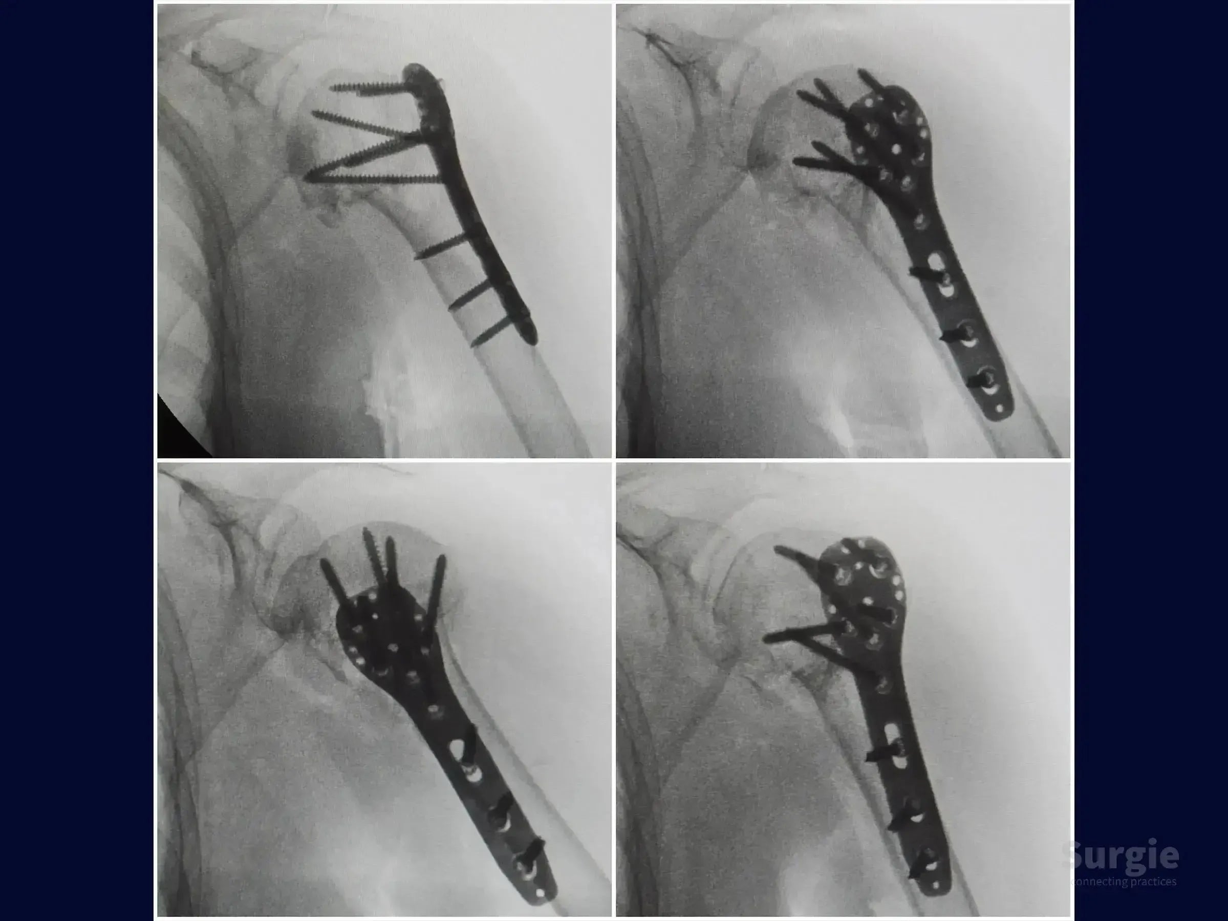 X-ray showing proximal humerus fracture fixation with a metal locking plate and multiple screws in four views.