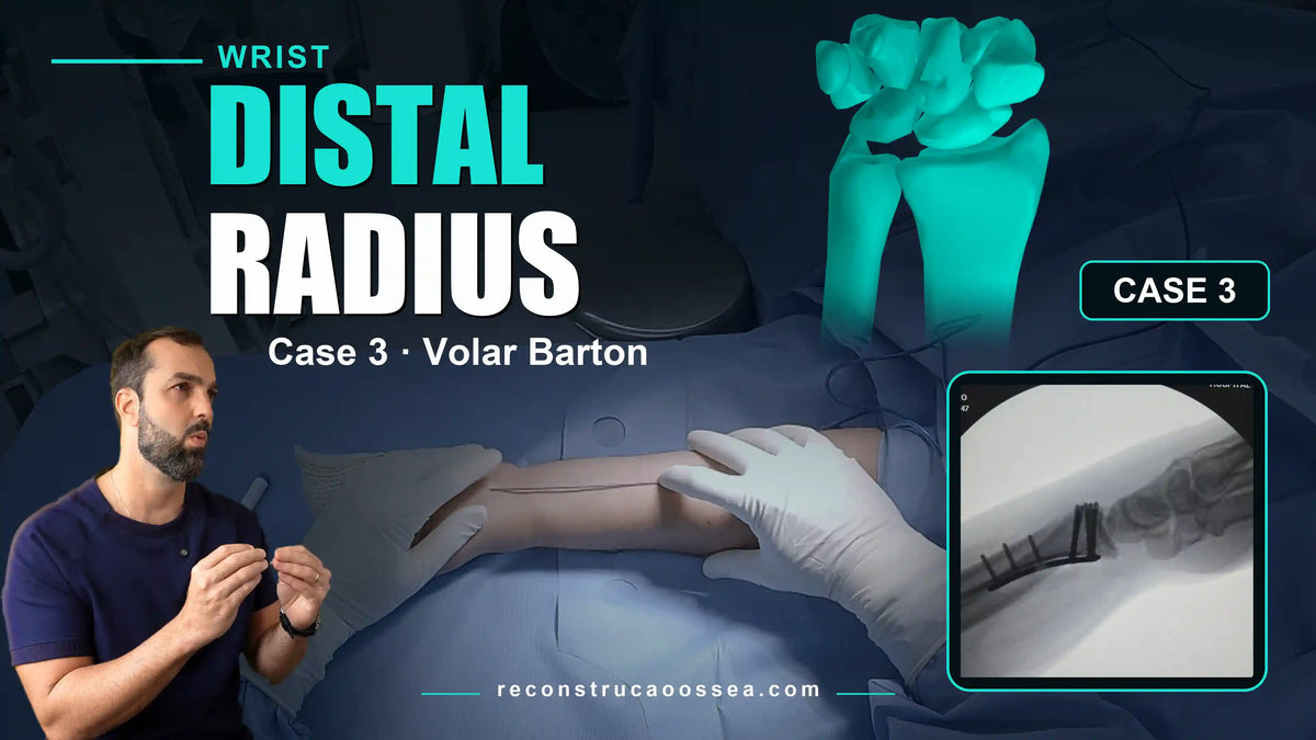 DISTAL RADIUS [CASE 03] - Volar Barton