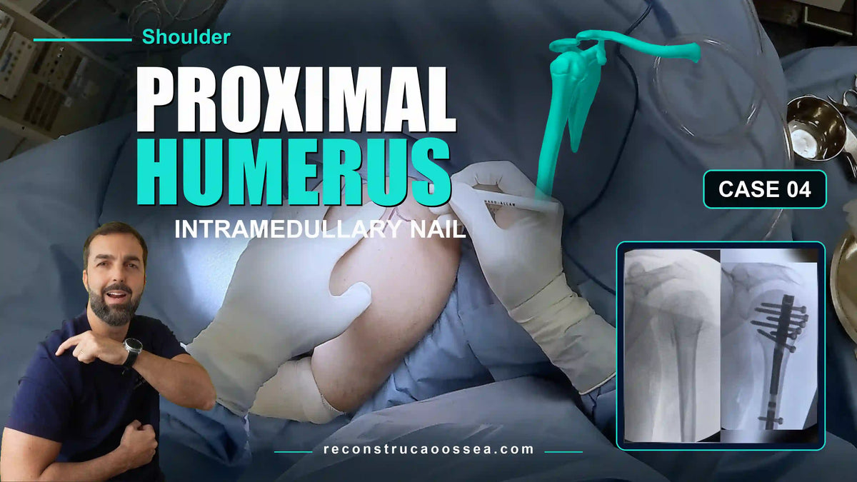 PROXIMAL HUMERUS [CASE 04] - Intramedullary Nail