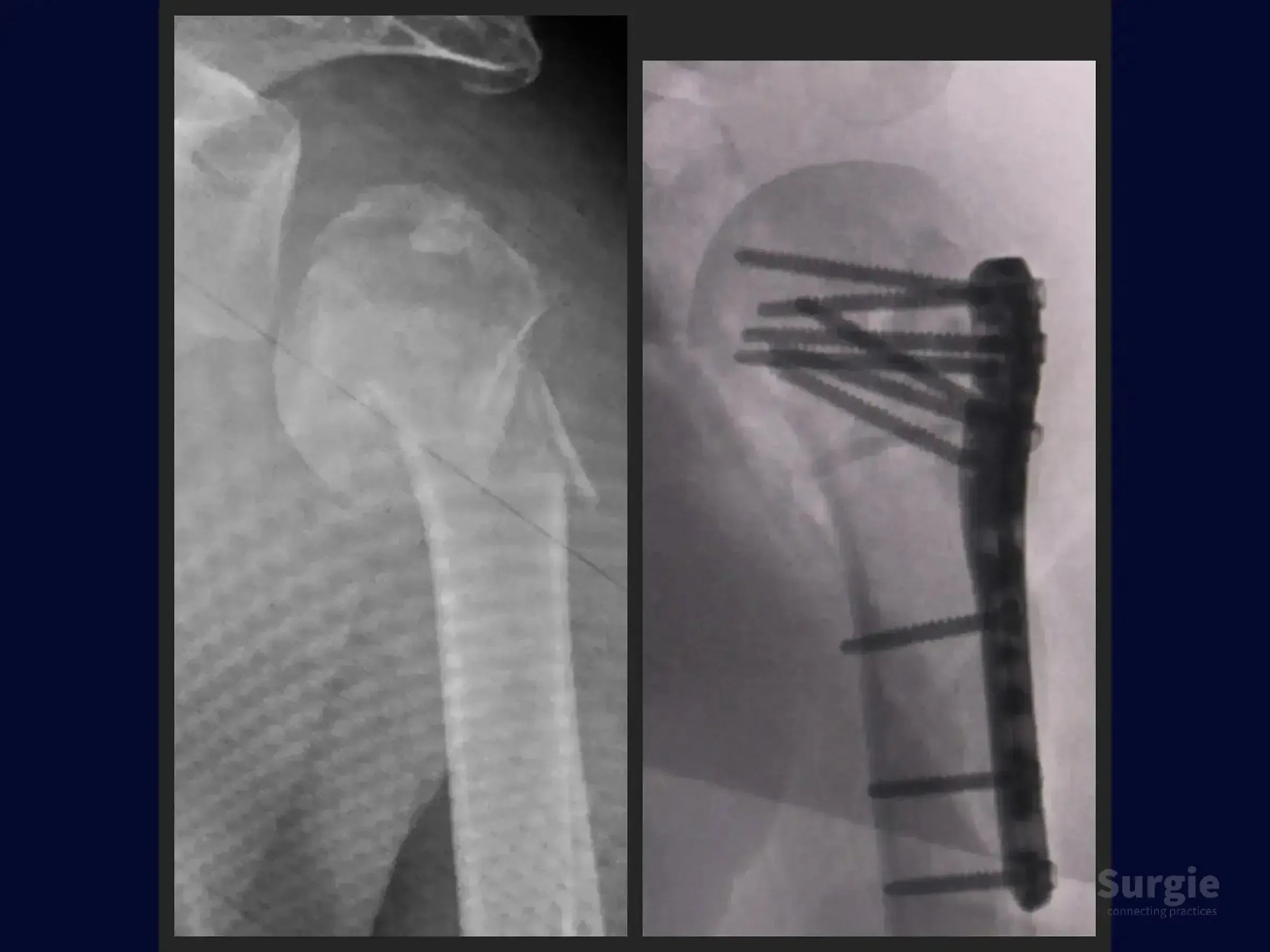 X-ray showing a complex four-part proximal humerus fracture before and after surgical plate and screw fixation.
