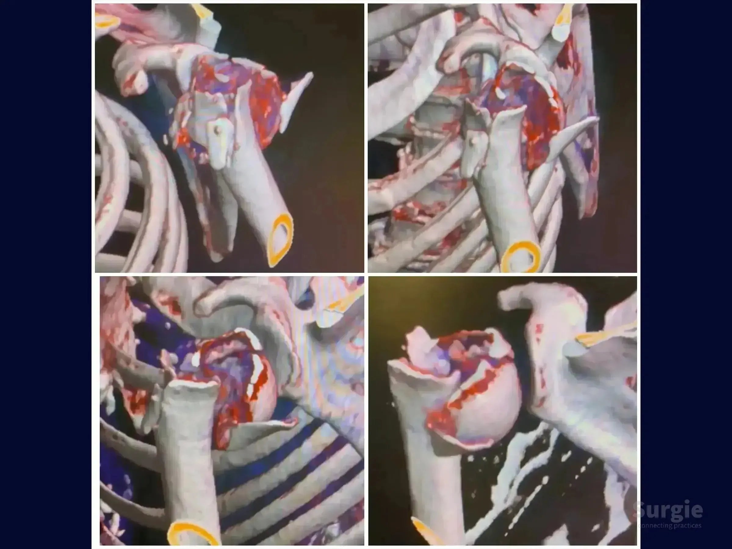 3D CT scan showing a complex four-part proximal humerus fracture from multiple surgical angles.