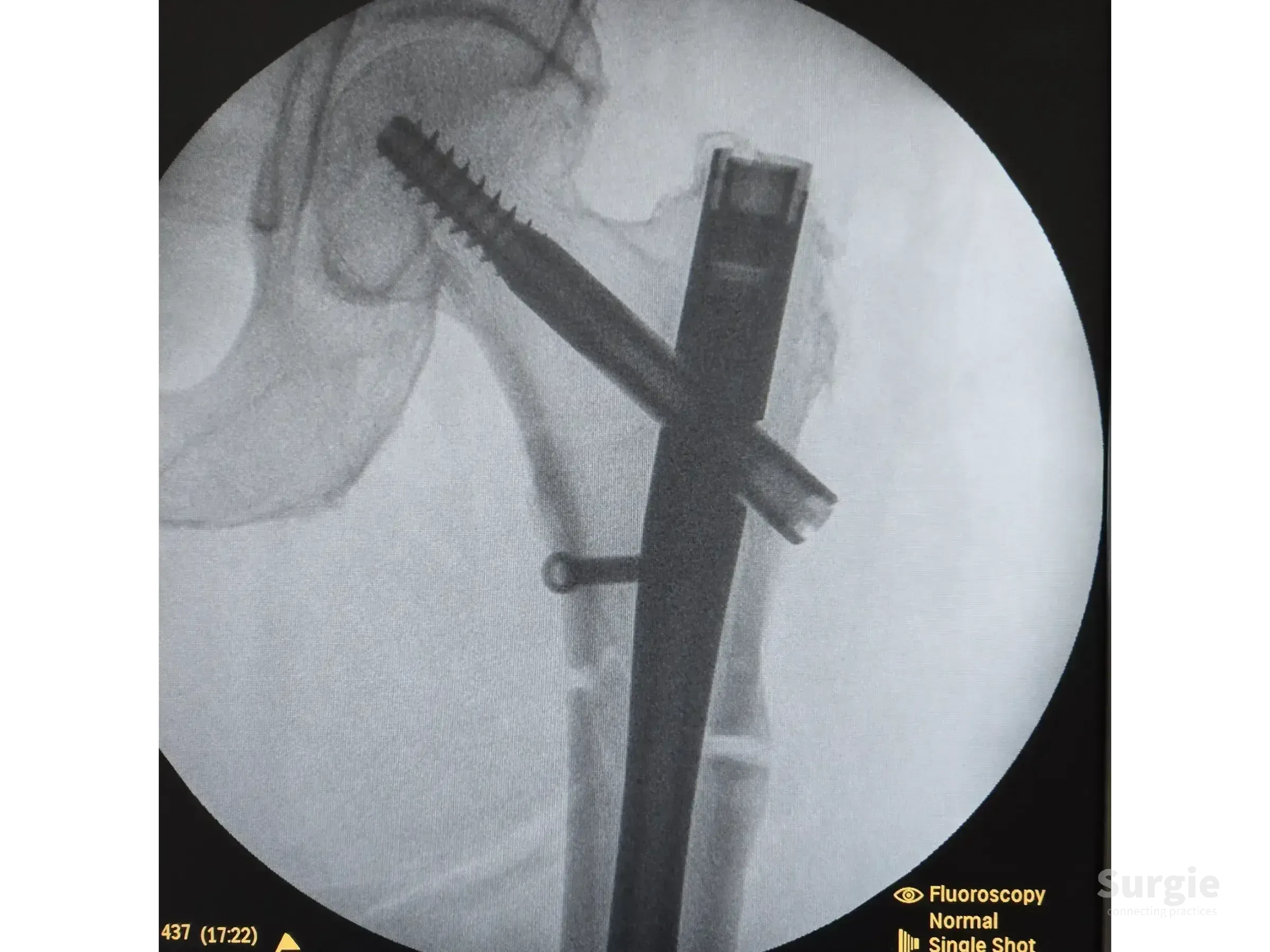 Fluoroscopic X-ray showing a metallic intramedullary nail implanted in a femur to treat a subtrochanteric fracture.
