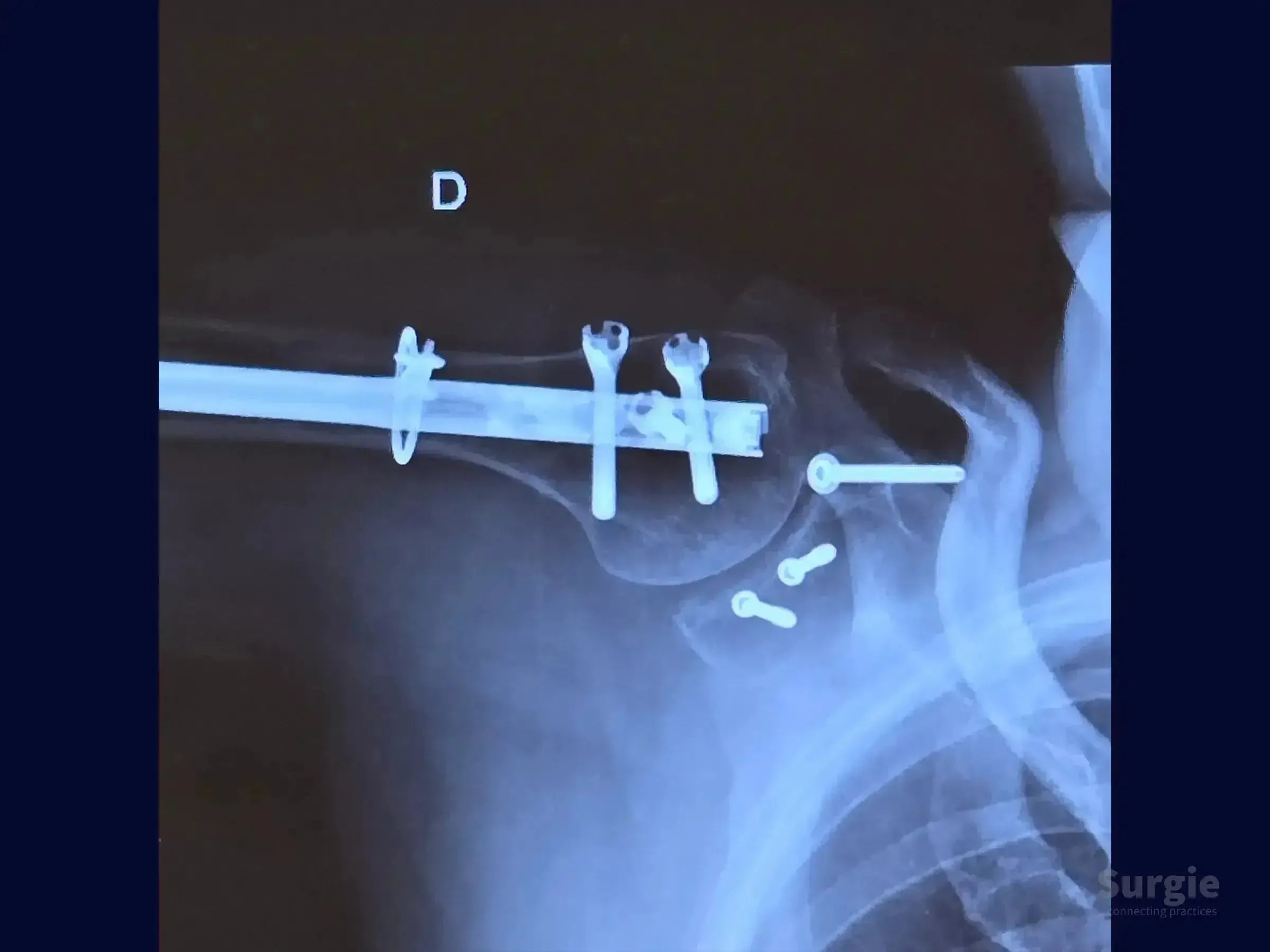 Shoulder X-ray showing humeral intramedullary nail, cerclage wire, and screw fixation in the glenoid and coracoid process.