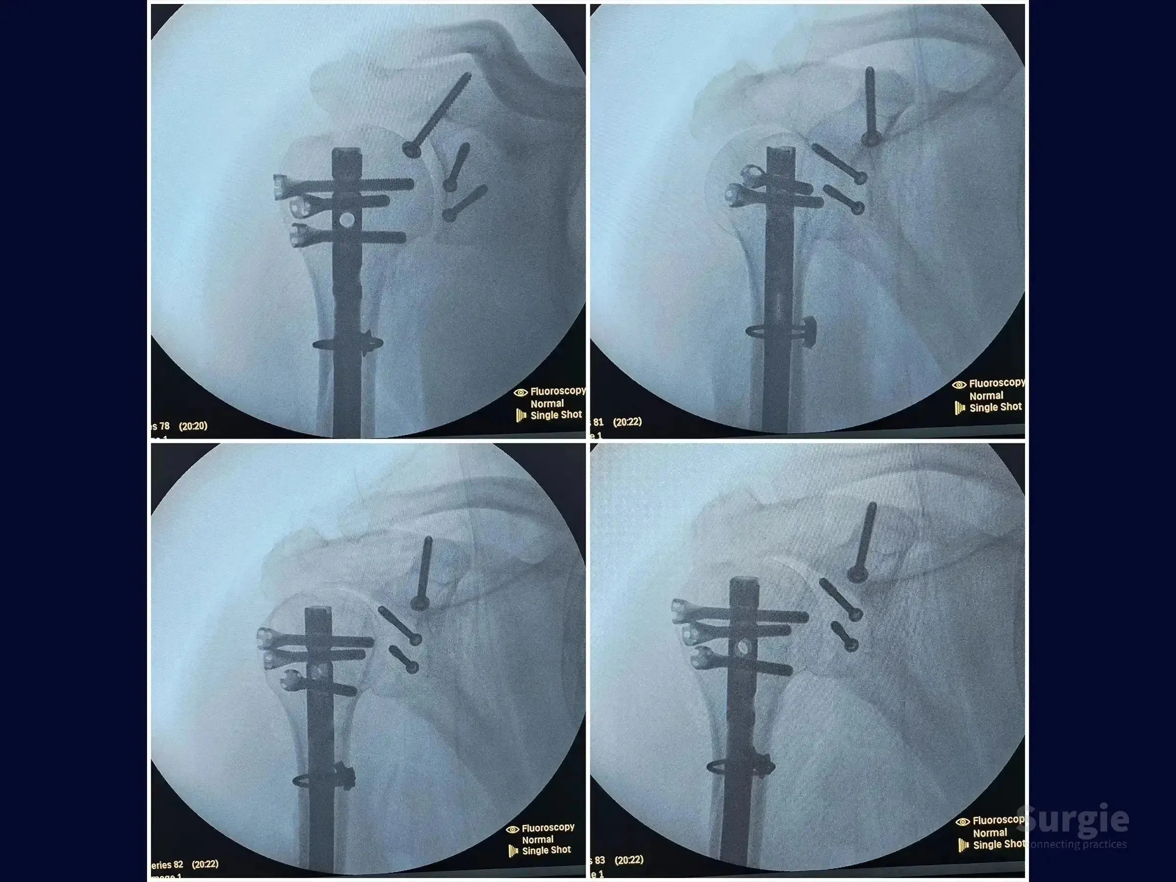 Fluoroscopy showing humeral intramedullary nail fixation with glenoid and coracoid process screw stabilization.