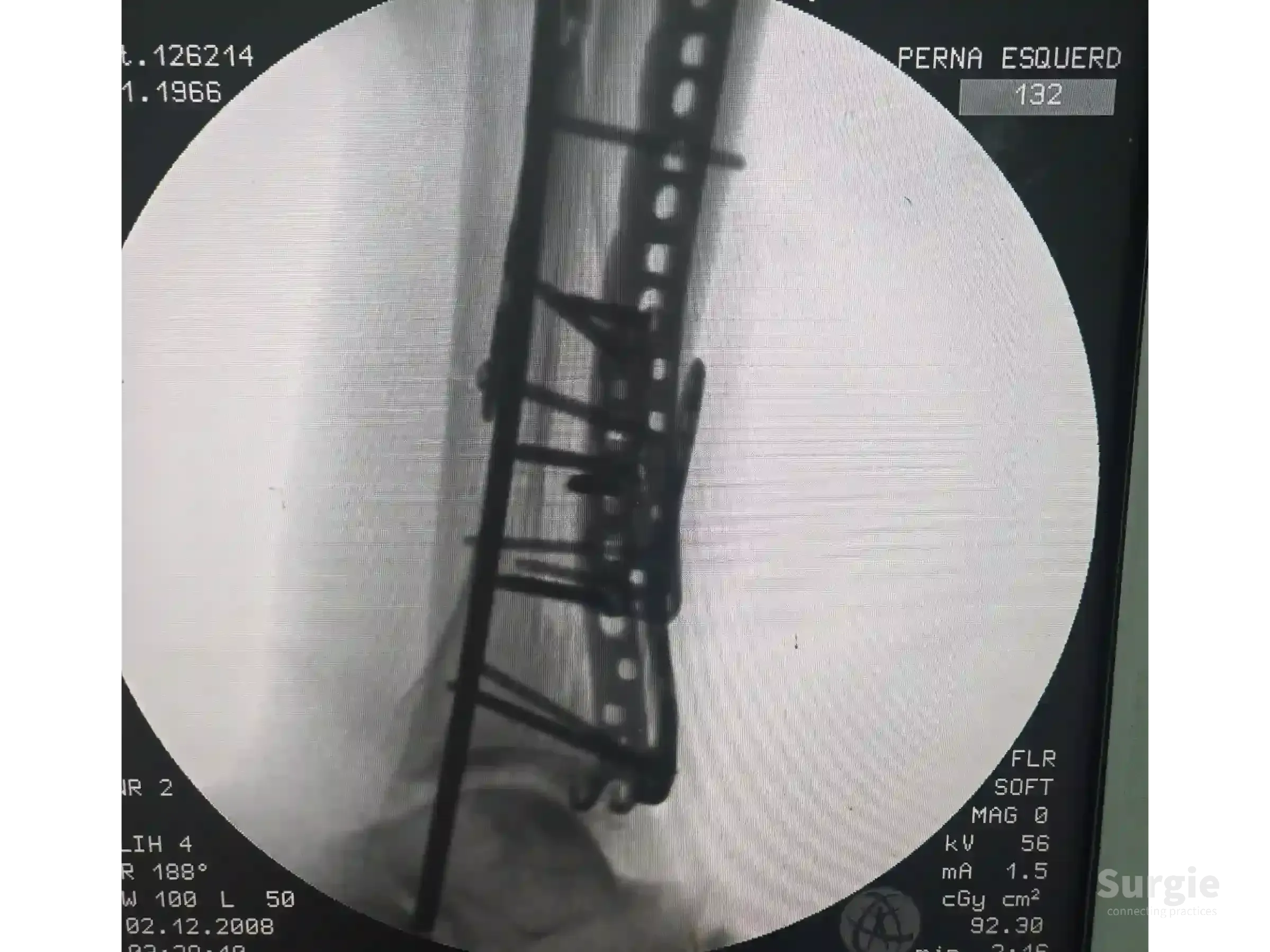Fluoroscopic X-ray showing a tibial pilon fracture stabilized with metal plates and screws in the ankle region.
