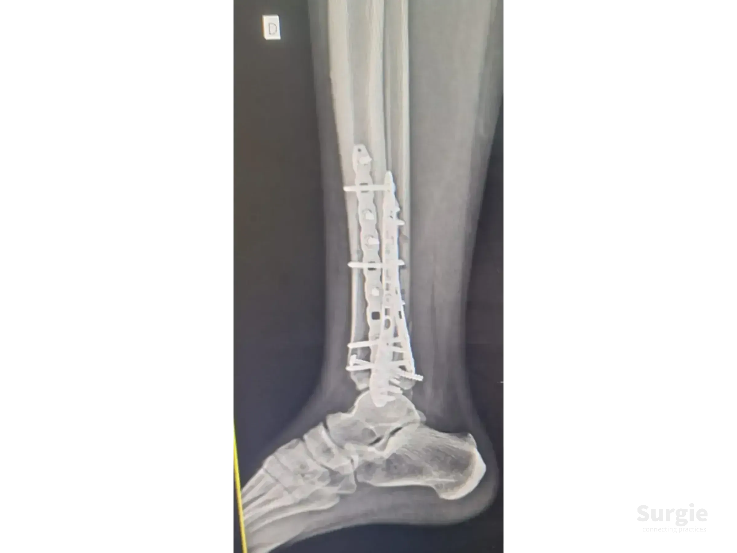Lateral X-ray of a tibial pilon fracture fixed with titanium plates and screws along the distal tibia and fibula.