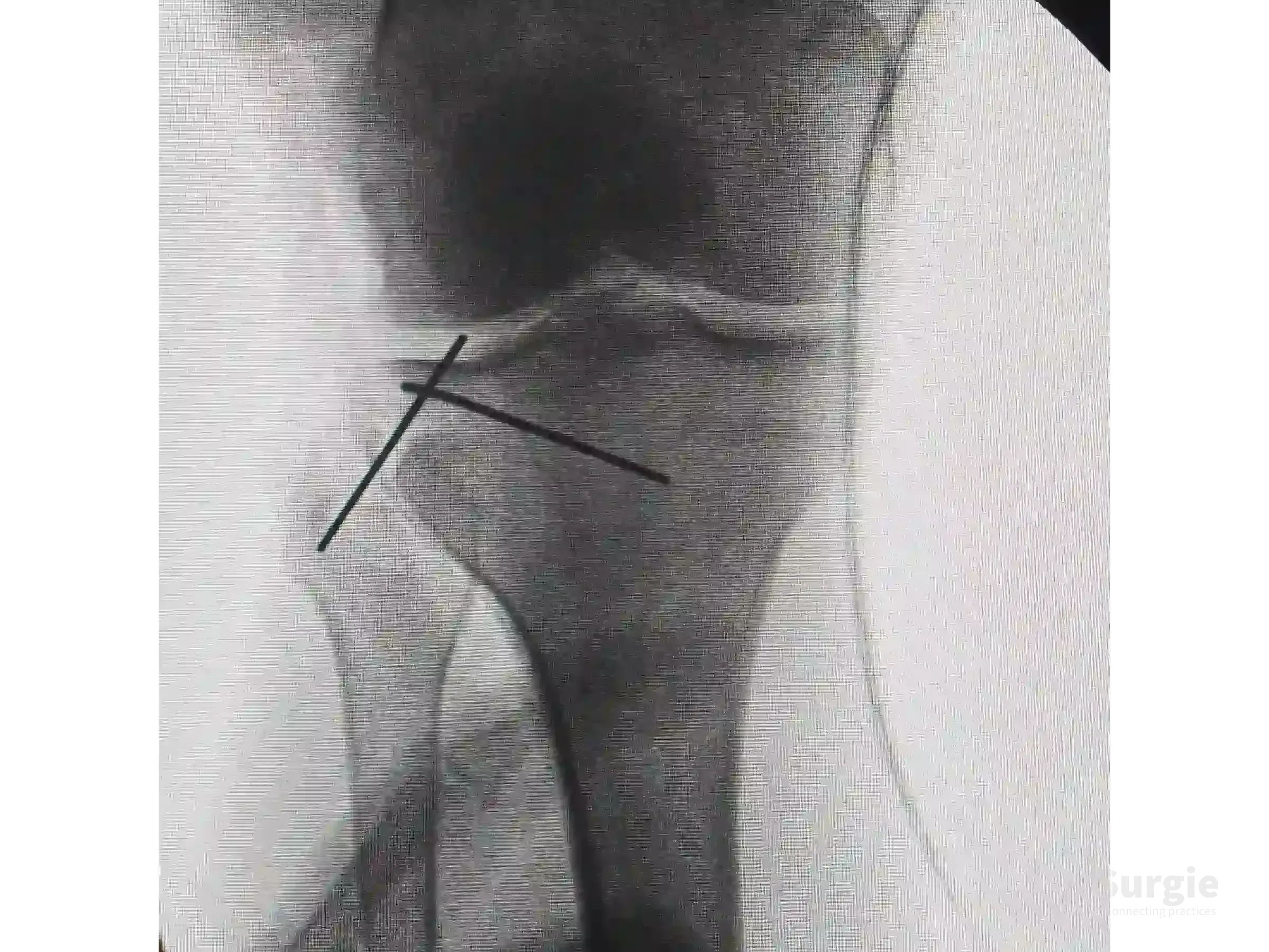 Fluoroscopic view of a tibial plateau fracture with guide wires placed for subchondral support of the lateral depression.