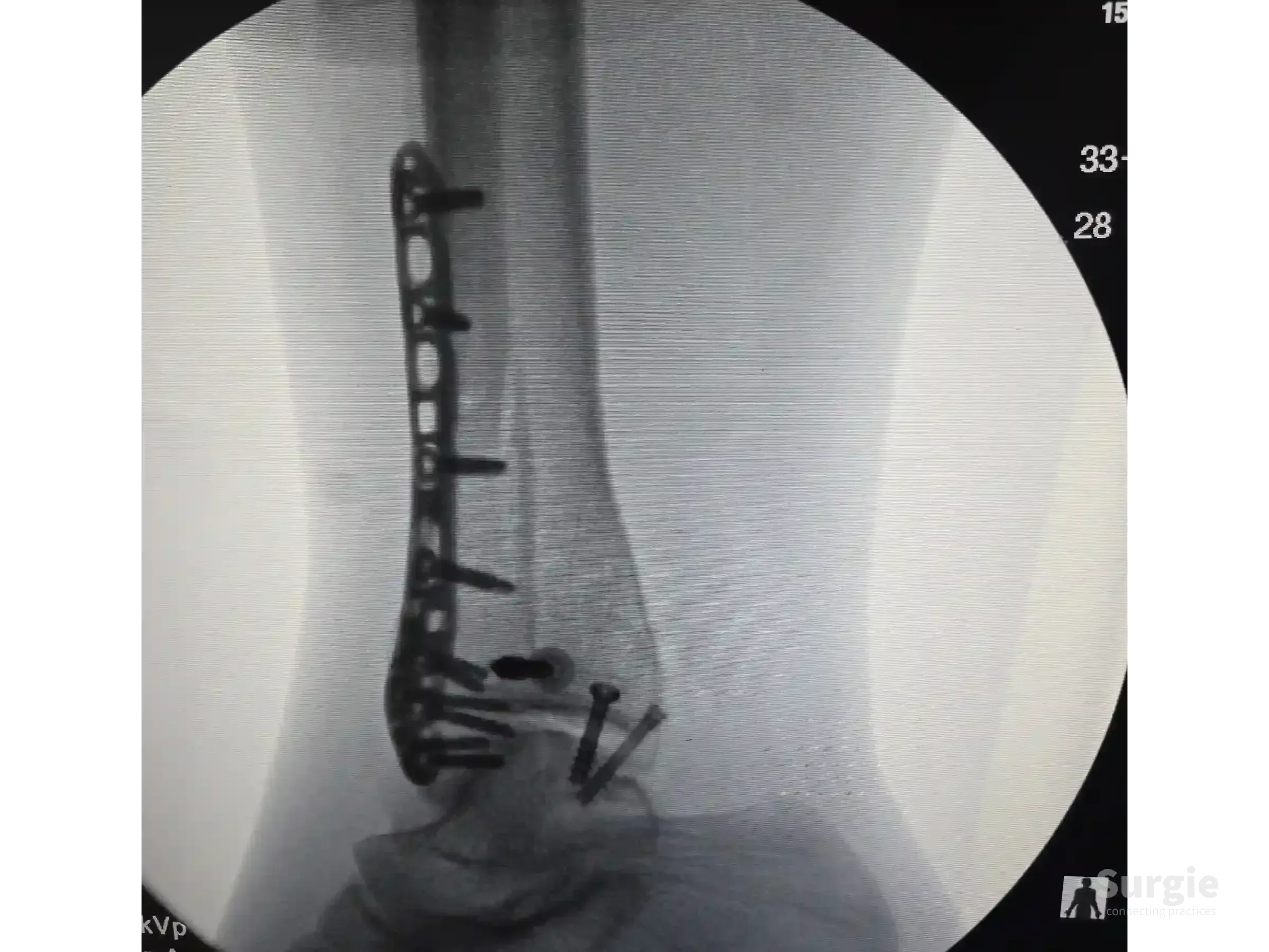 X-ray showing a metal plate and screws fixing a trimalleolar ankle fracture with an inverted medial malleolus fragment.