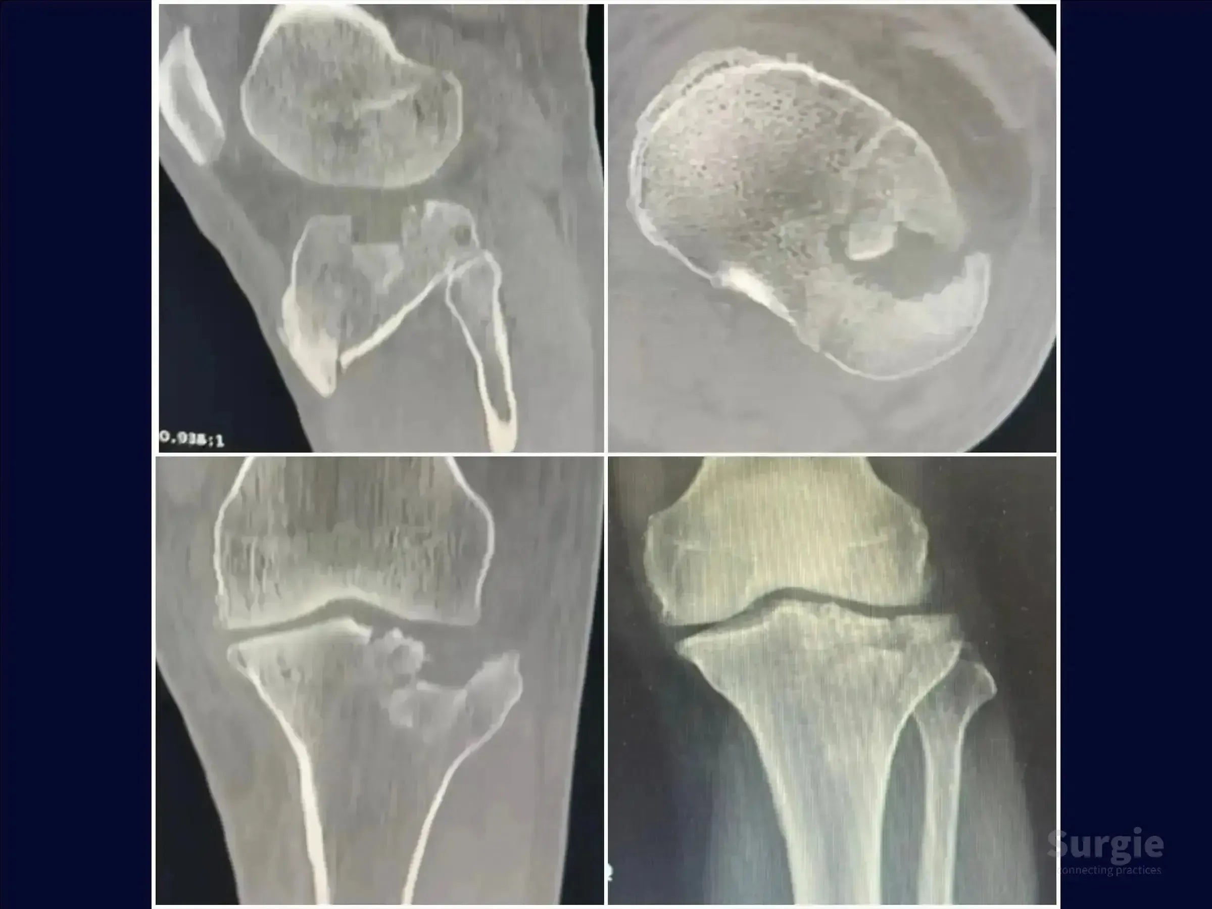 CT scan and X-ray views showing a tibial plateau fracture with central depression and articular surface displacement.