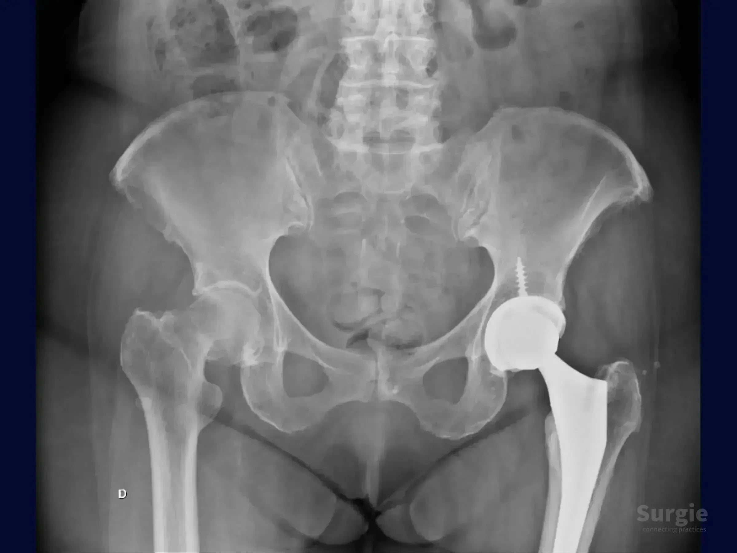 Pelvic X-ray showing a total hip arthroplasty with a press-fit acetabular cup, screw fixation, and an uncemented femoral stem.