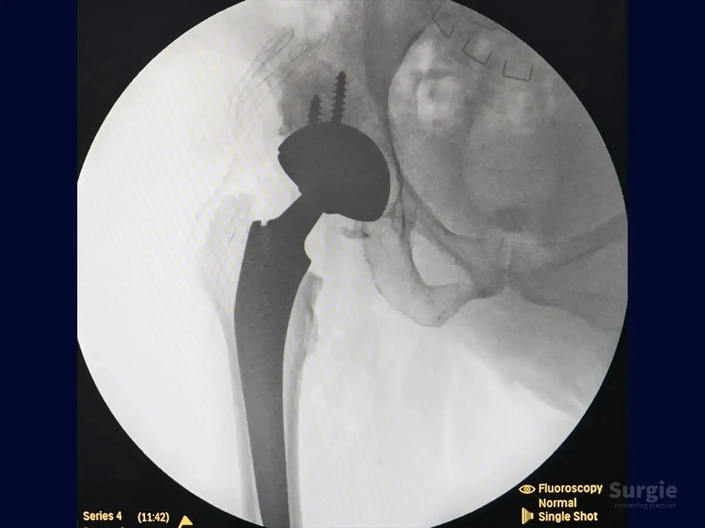 Fluoroscopic X-ray showing a total hip arthroplasty implant with acetabular screws and a femoral stem in the hip joint.